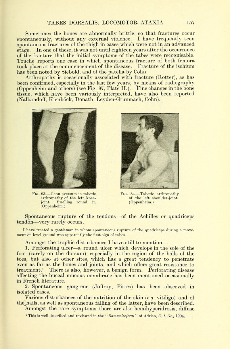 Sometimes the bones are abnormally brittle, so that fractures occur spontaneously, without any external violence. I have frequently seen spontaneous fractures of the thigh in cases which were not in an advanced stage. In one of these, it was not until eighteen years after the occurrence of the fracture that the initial symptoms of the tabes were recognisable. Touche reports one case in which spontaneous fracture of both femora took place at the commencement of the disease. Fracture of the ischium has been noted by Siebold, and of the patella by Cohn. Arthropathy is occasionally associated with fracture (Rotter), as has been confirmed, especially in the last few years, by means of radiography (Oppenheim and others) (see Fig. 8-7, Plate II.). Fine changes in the bone tissue, which have been varioiisly interpreted, have also been reported (Nalbandoff, Kienbock, Donath, Leyden-Grunmach, Cohn). Spontaneous rupture of the tendons—of the AchiUes or quadriceps tendon—very rarely occurs. I have treated a gentleman in whom spontaneous rupture of the quadriceps during a move- ment on level ground was apparently the first sign of tabes. Amongst the trophic disturbances I have still to mention— 1. Perforating ulcer—a round ulcer which develops in the sole of the foot (rarely on the dorsum), especially in the region of the balls of the toes, but also at other sites, which has a great tendency to penetrate even as far as the bones and joints, and which offers great resistance to treatment.^ There is also, however, a benign form. Perforating disease affecting the buccal mucous membrane has been mentioned occasionally in French literature. 2. Spontaneous gangrene (Joffroy, Pitres) has been observed in isolated cases. Various disturbances of the nutrition of the skin {e.g. vitiligo) and of the^nails, as well as spontaneous falhng of the latter, have been described. Amongst the rare symptoms there are also hemihyperidrosis, diffuse ^ This is well described and reviewed m the  Sa7nmelre.ferai  of Adrien, C. /. Or., 1904. 1 Fig. 83.—Genu eversum in tabetic arthropathy of the left knee- joint. Swelling round it. (Oppenheim.) Fig. 84.—Tabetic arthropathy of the left shoulder-joint. (Oppenheim.)