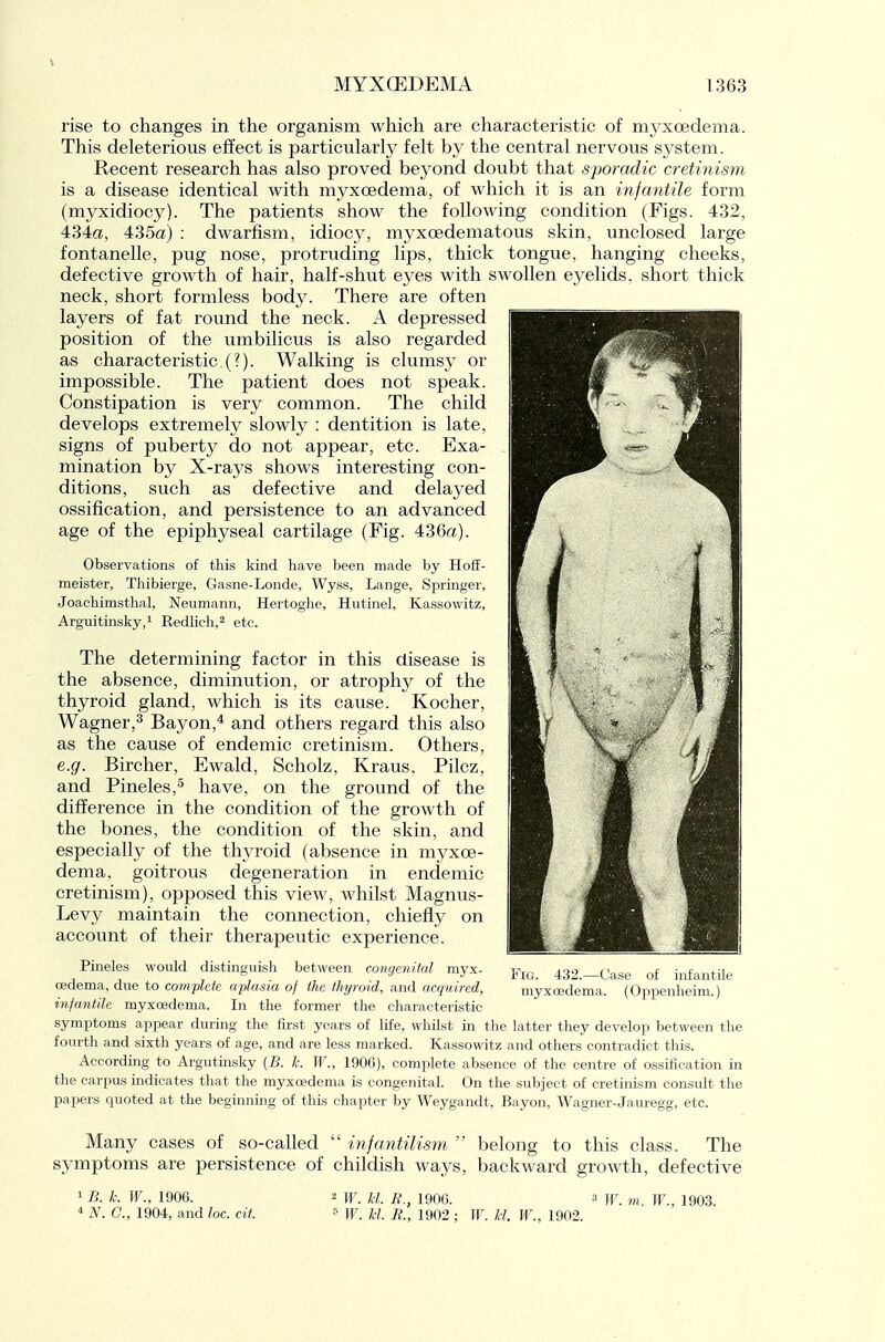V MYXGEDEMA 1363 rise to changes in the organism which are characteristic of myxoedema. This deleterious effect is particularly felt by the central nervous system. Recent research has also proved beyond doubt that sporadic cretinism is a disease identical with myxoedema, of which it is an infantile form (myxidiocy). The patients show the following condition (Figs. 432, 434a, 435a) : dwarfism, idiocj, myxoedematous skin, unclosed large fontanelle, pug nose, protruding lips, thick tongue, hanging cheeks, defective growth of hair, half-shut eyes with swollen e^^elids. short thick neck, short formless body. There are often layers of fat round the neck. A depressed position of the umbilicus is also regarded as characteristic (?). Walking is clums}- or impossible. The patient does not speak. Constipation is very common. The child develops extremely slowly : dentition is late, signs of puberty do not appear, etc. Exa- mination by X-rays shows interesting con- ditions, such as defective and delayed ossification, and persistence to an advanced age of the epiphyseal cartilage (Fig. 436a). Observations of this kind have been made by Hoff- meister, Thibieige, Gasne-Londe, Wyss, Lange, Springer, Joachimsthal, Neumann, Hertoghe, Hiitinel, Kassowitz, Arguitinsky,! RedHch,^ etc. The determining factor in this disease is the absence, diminution, or atrophy of the thyroid gland, which is its cause. Kocher, Wagner,^ Bayon,* and others regard this also as the cause of endemic cretinism. Others, e.g. Bircher, Ewald, Scholz, Kraus, Pilcz, and Pineles,^ have, on the ground of the difference in the condition of the growth of the bones, the condition of the skin, and especially of the thyroid (absence in myxoe- dema, goitrous degeneration in endemic cretinism), opposed this view, whilst Magnus- Levy maintain the connection, chiefly on account of their therapeutic experience. Pineles would distinguish between congenital myx- oedema, due to complete aplasia of the thyroid, and acquired, infantile myxoedema. In the former the characteristic symptoms appear during the first years of life, whilst in the latter they develop between the fourth and sixth years of age, and are less marked. Kassowitz and others contradict this. According to Argutinsky {B. k. W., 190C), complete absence of the centre of ossification in the carpus indicates that the myxoedema is congenital. On the subject of cretinism consult the papers quoted at the beginning of this chapter by Weygandt, Bayon, Wagner-Jauregg, etc. Many cases of so-called  infantilism  belong to this class. The symptoms are persistence of childish ways, backward growth, defective Fig. 432.—Case of infantile myxoedema. (Oppenheim.)