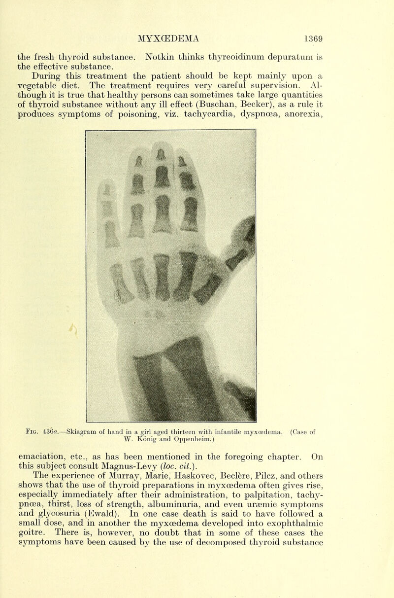 the fresh thyroid substance. Notkin thinks thyreoidinum depuratum is the effective substance. During this treatment the patient should be kept mainly upon a vegetable diet. The treatment requires very careful supervision. Al- though it is true that healthy persons can sometimes take large quantities of thyroid substance without any ill effect (Buschan, Becker), as a rule it produces symptoms of poisoning, viz. tachycardia, dyspnoea, anorexia, Fig. 436«.—Skiagram of hand in a girl aged thirteen with infantile myxcedema. (Case of W. Konig and Oppenheim.) emaciation, etc., as has been mentioned in the foregoing chapter. On this subject consult Magnus-Levy {loc. cit.). The experience of Murray, Marie, Haskovec, Becl^re, Pilcz, and others shows that the use of thyroid preparations in myxcedema often gives rise, especially immediately after their administration, to palpitation, tachy- pnoea, thirst, loss of strength, albuminuria, and even uraemic symptoms and glycosuria (Ewald). In one case death is said to have followed a small dose, and in another the myxcedema developed into exophthalmic goitre. There is, however, no doubt that in some of these cases the symptoms have been caused by the use of decomposed thyroid substance