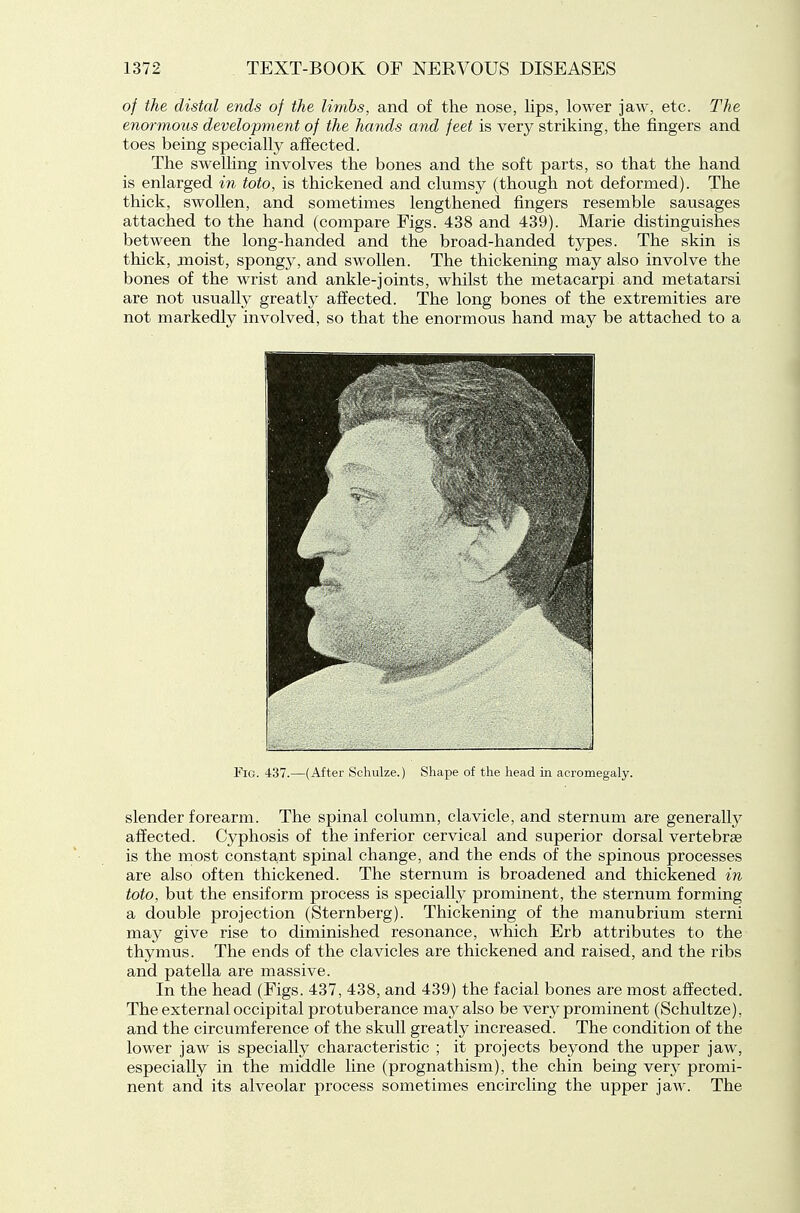 of the distal ends of the limbs, and of the nose, lips, lower jaw, etc. The enormous development of the hands and feet is very striking, the fingers and toes being specially affected. The swelling involves the bones and the soft parts, so that the hand is enlarged in toto, is thickened and clumsy (though not deformed). The thick, swollen, and sometimes lengthened fingers resemble sausages attached to the hand (compare Figs. 438 and 439). Marie distinguishes between the long-handed and the broad-handed types. The skin is thick, moist, spongy, and swollen. The thickening may also involve the bones of the wrist and ankle-joints, whilst the metacarpi and metatarsi are not usually greatly affected. The long bones of the extremities are not markedly involved, so that the enormous hand may be attached to a Fig. 437.—(After Schulze.) Shape of the head in acromegaly. slender forearm. The spinal column, clavicle, and sternum are generally affected. Cyphosis of the inferior cervical and superior dorsal vertebrae is the most consta,nt spinal change, and the ends of the spinous processes are also often thickened. The sternum is broadened and thickened in toto, but the ensiform process is specially prominent, the sternum forming a double projection (Sternberg). Thickening of the manubrium sterni may give rise to diminished resonance, which Erb attributes to the thymus. The ends of the clavicles are thickened and raised, and the ribs and patella are massive. In the head (Figs. 437, 438, and 439) the facial bones are most affected. The external occipital protuberance may also be very prominent (Schultze), and the circumference of the skull greatly increased. The condition of the lower jaw is specially characteristic ; it projects beyond the upper jaw, especially in the middle line (prognathism), the chin being very promi- nent and its alveolar process sometimes encircling the upper jaw. The