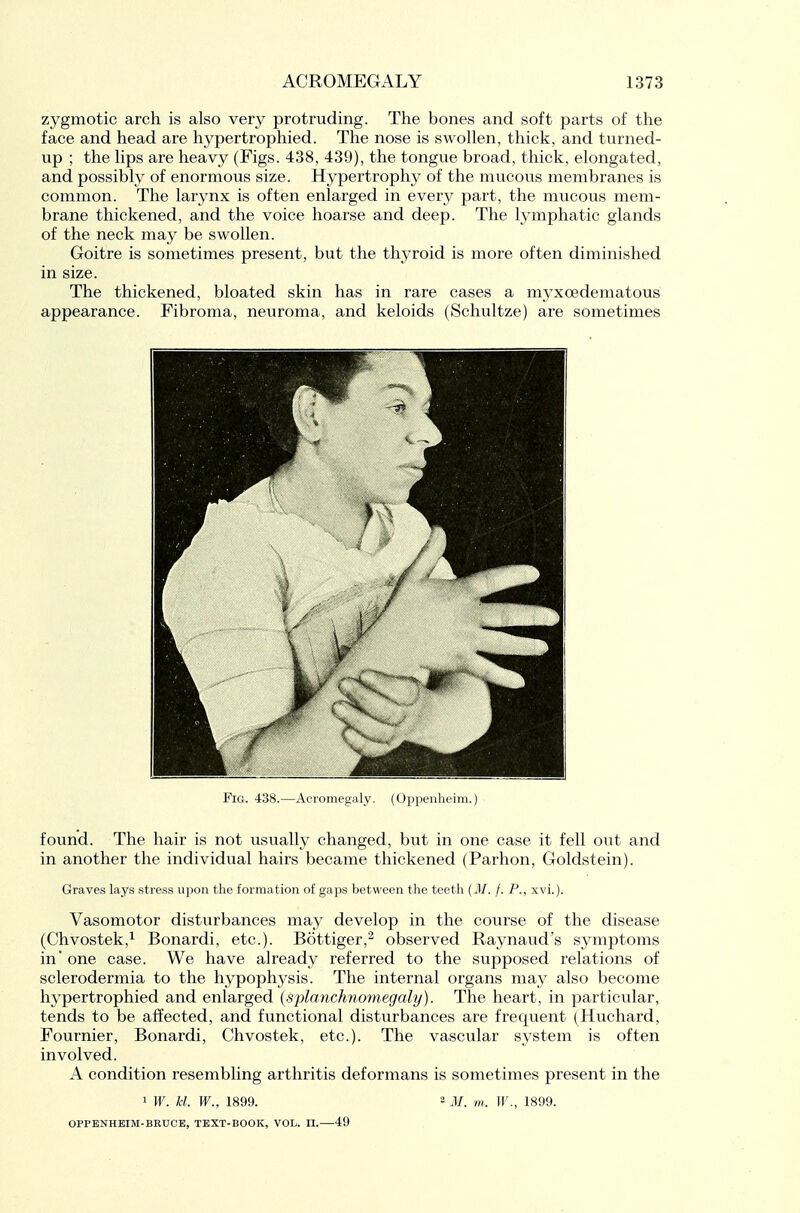 zygmotic arch is also very protruding. The bones and soft parts of the face and head are hypertrophied. The nose is swollen, thick, and turned- up ; the lips are heavy (Figs. 438, 439), the tongue broad, thick, elongated, and possibly of enormous size. Hypertrophy of the mucous membranes is common. The larynx is often enlarged in every part, the mucous mem- brane thickened, and the voice hoarse and deep. The lymphatic glands of the neck may be swollen. Goitre is sometimes present, but the thyroid is more often diminished in size. The thickened, bloated skin has in rare cases a myxoedematous appearance. Fibroma, neuroma, and keloids (Schultze) are sometimes Fig. 438.—Aciomegaly. (Oppenlieim.) found. The hair is not usually changed, but in one case it fell out and in another the individual hairs became thickened (Parhon, Goldstein). Graves lays stress upon the formation of gaps between the teeth (J/. /. P., xvi.). Vasomotor disturbances may develop in the course of the disease (Chvostek,^ Bonardi, etc.). Bottiger,'^ observed Raynaud's symptoms in' one case. We have already referred to the supposed relations of sclerodermia to the hypophysis. The internal organs may also become hypertrophied and enlarged {splanchnomegaly). The heart, in particular, tends to be affected, and functional disturbances are frequent (Huchard, Fournier, Bonardi, Chvostek, etc.). The vascular system is often involved. A condition resembling arthritis deformans is sometimes present in the 1 W. kl. W., 1899. 2 j/_ lY., 1899. OPPENHEIM-BRUCE, TEXT-BOOK, VOL. II. 49