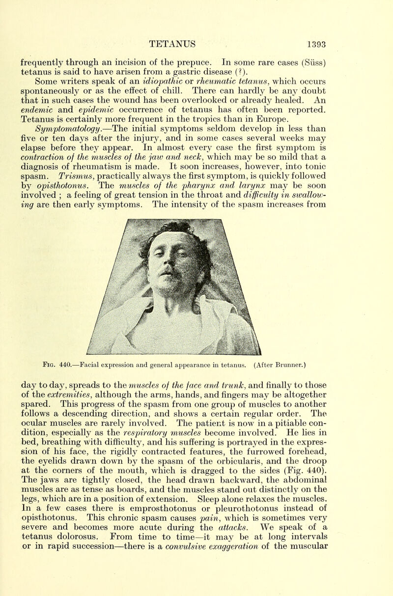 frequently through an incision of the prepuce. In some rare cases (Siiss) tetanus is said to have arisen from a gastric disease (?). Some writers speak of an idiopathic or rheimiatic tetanus, which occurs spontaneously or as the effect of chill. There can hardly be any doubt that in such cases the wound has been overlooked or already healed. An endemic and epidemic occurrence of tetanus has often been reported. Tetanus is certainly more frequent in the tropics than in Europe. Symptomatology.—The initial symptoms seldom develop in less than five or ten days after the injury, and in some cases several weeks may elapse before they appear. In almost every case the first symptom is contraction of the muscles of the jaio and neck, which may be so mild that a diagnosis of rheumatism is made. It soon increases, however, into tonic spasm. Trismus, practically always the first symptom, is quickly followed by opisthotonus. The muscles of the pharynx and larynx may be soon involved ; a feeling of great tension in the throat and difffciUty in swallow- ing are then early symptoms. The intensity of the spasm increases from Fig. 440.—Facial expression and general appearance in tetanus. (After Brunner.) day to day, spreads to the 7nuscles of the face and trunk, and finally to those of the extremities, although the arms, hands, and fingers may be altogether spared. This progress of the spasm from one group of muscles to another follows a descending direction, and shows a certain regular order. The ocular muscles are rarely involved. The patient is now in a pitiable con- dition, especially as the respiratory fnuscles become involved. He lies in bed, breathing with difficulty, and his suffering is portrayed in the expres- sion of his face, the rigidly contracted features, the furrowed forehead, the eyelids drawn down by the spasm of the orbicularis, and the droop at the corners of the mouth, which is dragged to the sides (Fig. 440). The jaws are tightly closed, the head drawn backward, the abdominal muscles are as tense as boards, and the muscles stand out distinctly on the legs, which are in a position of extension. Sleep alone relaxes the muscles. In a few cases there is emprosthotonus or pleurothotonus instead of opisthotonus. This chronic spasm causes pai7i, Avhich is sometimes very severe and becomes more acute during the attacks. We speak of a tetanus dolorosus. From time to time—it may be at long intervals or in rapid succession—there is a convulsive exaggeration of the muscular