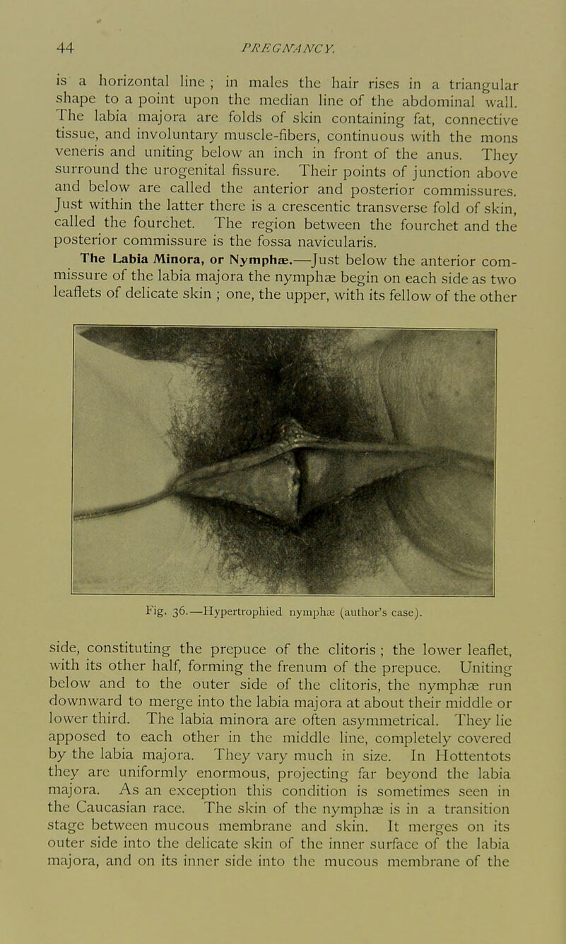 is a horizontal line ; in males the hair rises in a triangular shape to a point upon the median line of the abdominal wall. The labia majora are folds of skin containing fat, connective tissue, and involuntary muscle-fibers, continuous with the mons veneris and uniting below an inch in front of the anus. They surround the urogenital fissure. Their points of junction above and below are called the anterior and posterior commissures. Just within the latter there is a crescentic transverse fold of skin, called the fourchet. The region between the fourchet and the posterior commissure is the fossa navicularis. The Labia Minora, or Nymphje.—Just below the anterior com- missure of the labia majora the nymphae begin on each side as two leaflets of delicate skin ; one, the upper, with its fellow of the other Fig. 36.—Hypertrophied nymphte (author's case). side, constituting the prepuce of the clitoris ; the lower leaflet, with its other half, forming the frenum of the prepuce. Uniting bel ow and to the outer side of the clitoris, the nymphae run downward to merge into the labia majora at about their middle or lower third. The labia minora are often asymmetrical. They lie apposed to each other in the middle line, completely covered by the labia majora. They vary much in size. In Hottentots they are uniformly enormous, projecting far beyond the labia majora. As an exception this condition is sometimes seen in the Caucasian race. The skin of the nymphae is in a transition stage between mucous membrane and skin. It merges on its outer side into the delicate skin of the inner surface of the labia majora, and on its inner side into the mucous membrane of the