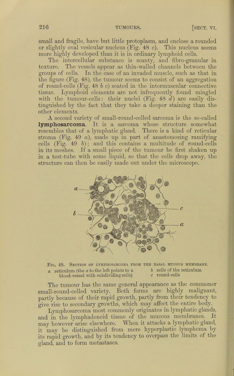 small and fragile, have but little protoplasm, and enclose a rounded or slightly oval vesicular nucleus (Fig. 48 c). This nucleus seems more highly developed than it is in ordinary lymphoid cells. The intercellular substance is scanty, and fibro-granular in texture. The vessels appear as thin-walled channels between the groups of cells. In the case of an invaded muscle, such as that in the figure (Fig. 48), the tumour seems to consist of an aggregation of round-cells (Fig. 48 b c) seated in the intermuscular connective tissue. Lymphoid elements are not infrequently found mingled with the tumour-cells: their nuclei (Fig. 48 d) are easily dis- tinguished by the fact that they take a deeper staining than the other elements. A second variety of small-round-celled sarcoma is the so-called lymphosarcoma. It is a sarcoma whose structure somewhat resembles that of a lymphatic gland. There is a kind of reticular stroma (Fig. 49 a), made up in part of anastomosing ramifying cells (Fig. 49 b); and this contains a multitude of round-cells in its meshes. If a small piece of the tumour be first shaken up in a test-tube with some liquid, so that the cells drop away, the structure can then be easily made out under the microscope. Fig. 49. Section or lymphosarcoma from the nasal mucous membrane. a reticulum (the a to the left points to a b cells of the reticulum blood-vessel with subdividing cells) c round-cells The tumour has the same general appearance as the commoner small-round-celled variety. Both forms are highly malignant, partly because of their rapid growth, partly from their tendency to give rise to secondary growths, which may affect the entire body. Lymphosarcoma most commonly originates in lymphatic glands, and in the lymphadenoid tissue of the mucous membranes. It may however arise elsewhere. When it attacks a lymphatic gland, it may be distinguished from mere hyperplastic lymphoma by its rapid growth, and by its tendency to overpass the limits of the gland, and to form metastases.