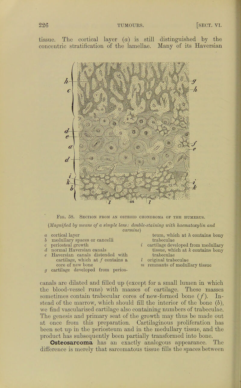 tissue. The cortical layer (a) is still distinguished by the concentric stratification of the lamellae. Many of its Haversian Fig. 58. Section from an osteoid (Magnified by means of a simple lens: doi carmin a cortical layer b medullary spaces or cancelli c periosteal growth d normal Haversian canals e Haversian canals distended with cartilage, which at / contains a core of new bone g cartilage developed from perios- CHONDROHA OF THE HUMERUS. ble-staining with haematoxglin and ') teum, which at 7j contains bony trabeculae t cartilage developed from medullary tissue, which at k contains bony trabeculae Z original trabeculae vi remnants of medullary tissue canals are dilated and filled up (except for a small lumen in which the blood-vessel runs) with masses of cartilage. These masses sometimes contain trabecular cores of new-formed bone (/). In- stead of the marrow, which should fill the interior of the bone (b), we find vascularised cartilage also containing numbers of trabeculae. The genesis and primary seat of the growth may thus be made out at once from this preparation. Cartilaginous proliferation has been set up in the periosteum and in the medullary tissue, and the product has subsequently been partially transformed into bone. Osteosarcoma has an exactly analogous appearance. The difference is merely that sarcomatous tissue fills the spaces between