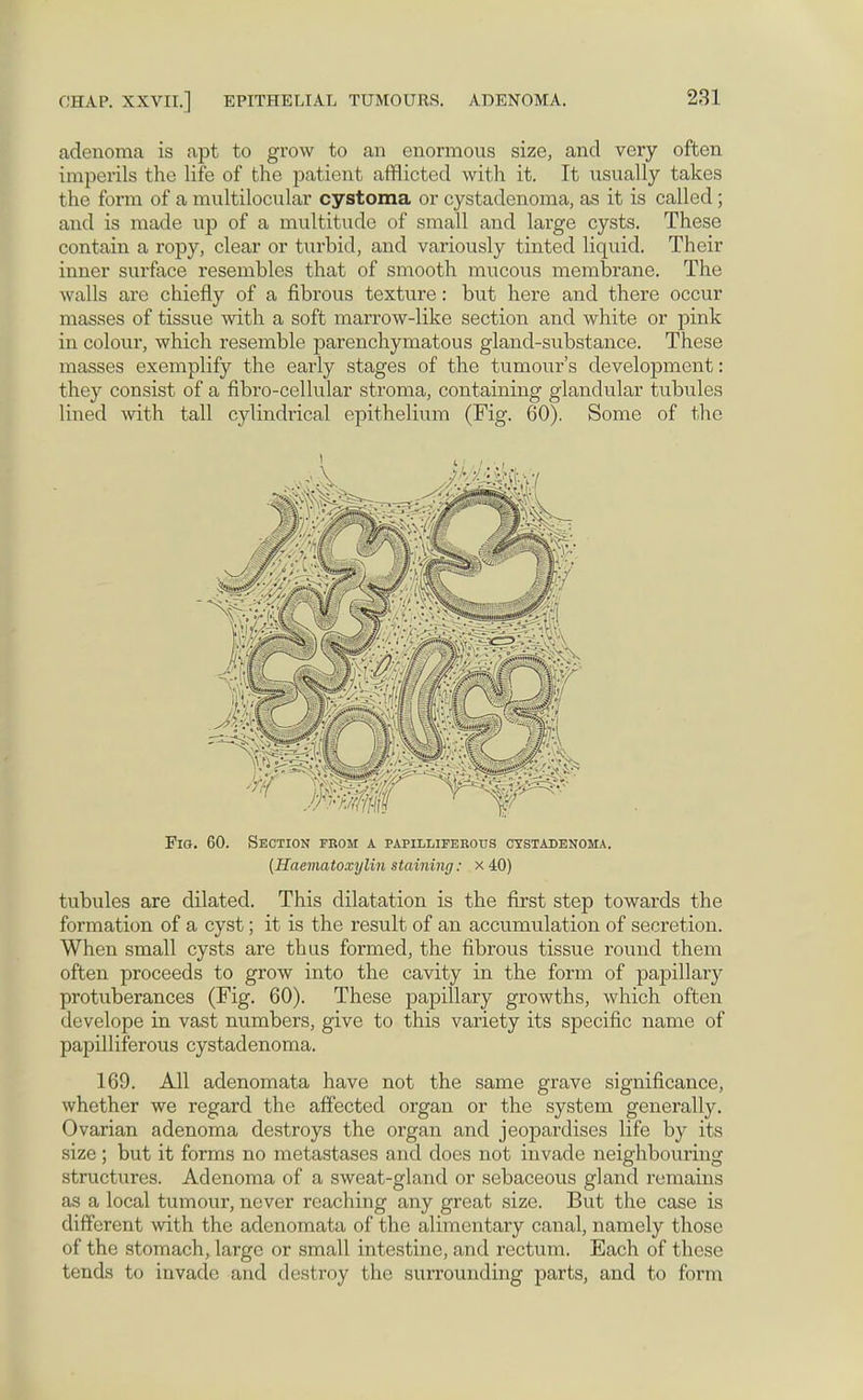 adenoma is apt to grow to an enormous size, and very often imperils the life of the patient afflicted with it. It usually takes the form of a multilocular cystoma or cystadenoma, as it is called; and is made up of a multitude of small and large cysts. These contain a ropy, clear or turbid, and variously tinted liquid. Their inner surface resembles that of smooth mucous membrane. The walls are chiefly of a fibrous texture: but here and there occur masses of tissue with a soft marrow-like section and white or pink in colour, which resemble parenchymatous gland-substance. These masses exemplify the early stages of the tumour's development: they consist of a fibro-celhilar stroma, containing glandular tubules lined with tall cylindrical epithelium (Fig. 60). Some of the Fig. 60. Section from a papuliferous cystadenoma. (Haematoxylin staining: x 40) tubules are dilated. This dilatation is the first step towards the formation of a cyst; it is the result of an accumulation of secretion. When small cysts are thus formed, the fibrous tissue round them often proceeds to grow into the cavity in the form of papillary protuberances (Fig. 60). These papillary growths, which often develope in vast numbers, give to this variety its specific name of papuliferous cystadenoma. 169. All adenomata have not the same grave significance, whether we regard the affected organ or the system generally. Ovarian adenoma destroys the organ and jeopardises life by its size; but it forms no metastases and does not invade neighbouring structures. Adenoma of a sweat-gland or sebaceous gland remains as a local tumour, never reaching any great size. But the case is different with the adenomata of the alimentary canal, namely those of the stomach, large or small intestine, and rectum. Each of these tends to invade and destroy the surrounding parts, and to form