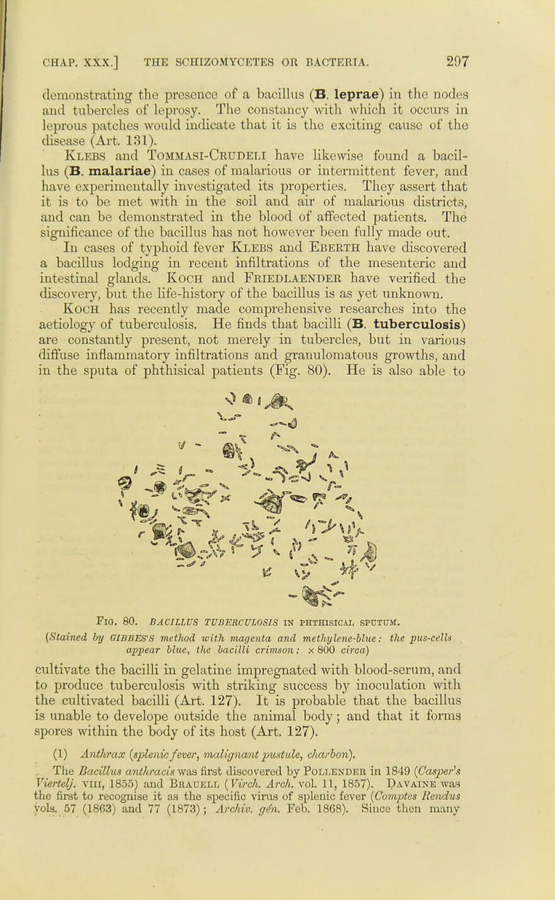 demonstrating the presence of a bacillus (B. leprae) in the nodes and tubercles of leprosy. The constancy with which it occurs in leprous patches would indicate that it is the exciting cause of the disease (Art. 131). Klebs and Tommasi-Crudeli have likewise found a bacil- lus (B. malariae) in cases of malarious or intermittent fever, and have experimentally investigated its properties. They assert that it is to be met with in the soil and air of malarious districts, and can be demonstrated in the blood of affected patients. The significance of the bacillus has not however been fully made out. In cases of typhoid fever Klebs and Eberth have discovered a bacillus lodging in recent infiltrations of the mesenteric and intestinal glands. Koch and Friedlaender have verified the discovery, but the life-history of the bacillus is as yet unknown. Koch has recently made comprehensive researches into the aetiology of tuberculosis. He finds that bacilli (B. tuberculosis) are constantly present, not merely in tubercles, but in various diffuse inflammatory infiltrations and granulomatous growths, and in the sputa of phthisical patients (Fig. 80). He is also able to Fig. 80. bacillus tuberculosis in phthisical sputum. (Stained by GIBBES'S method with magenta and methylene-blue: the pus-cells appear blue, the bacilli crimson: x 800 circa) cultivate the bacilli in gelatine impregnated with blood-serum, and to produce tuberculosis with striking success by inoculation with the cultivated bacilli (Art. 127). It is probable that the bacillus is unable to develope outside the animal body; and that it forms spores within the body of its host (Art. 127). (1) Anthrax (splenic fever, malignant pustule, charbon). The Bacillus anthracis was first discovered by Pollender in 1849 (Casper's Viertelj. Yin, 1855) and Brauell (Virch. Arch. vol. 11, 1857). Davaine was the first to recognise it as the specific virus of splenic fever (Comptes Rendus vols. 57 (1863) and 77 (1873); Archiv. gdn. Feb. 1868). Since then many