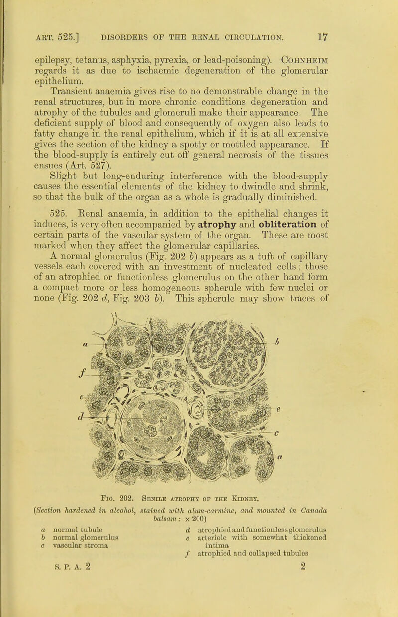 epilepsy, tetanus, asphyxia, pyrexia, or lead-poisoning). Cohnheim regards it as due to ischaemic degeneration of the glomerular epithelium. Transient anaemia gives rise to no demonstrable change in the renal structures, but in more chronic conditions degeneration and atrophy of the tubules and glomeruli make their appearance. The deficient supply of blood and consequently of oxygen also leads to fatty change in the renal epithelium, which if it is at all extensive gives the section of the kidney a spotty or mottled appearance. If the blood-supply is entirely cut off general necrosis of the tissues ensues (Art. 527). Slight but long-enduring interference with the blood-supply causes the essential elements of the kidney to dwindle and shrink, so that the bulk of the organ as a whole is gradually diminished. 525. Renal anaemia, in addition to the epithelial changes it induces, is very often accompanied by atrophy and obliteration of certain parts of the vascular system, of the organ. These are most marked when they affect the glomerular capillaries. A normal glomerulus (Fig. 202 b) appears as a tuft of capillary vessels each covered with an investment of nucleated cells; those of an atrophied or functionless glomerulus on the other hand form a compact more or less homogeneous spherule with few nuclei or none (Fig. 202 d, Fig. 203 b). This spherule may show traces of Fio. 202. Senile atrophy oj? the Kidney. (Section hardened in alcohol, stained with alum-carmine, and mounted in Canada balsam: x 200) a normal tubulo d atrophied and functionless glomerulus b normal glomerulus a arteriole with somewhat tbickonod c vascular stroma intirna / atrophied and collapsed tubules S. P. A. 2 2