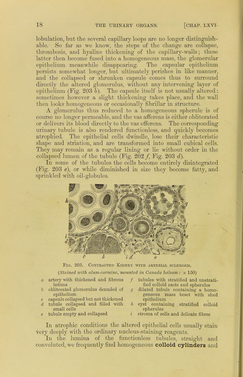 lobulation, but the several capillary loops are no longer distinguish- able. So far as we know, the steps of the change are collapse, thrombosis, and hyaline thickening of the capillary-walls; these latter then become fused into a homogeneous mass, the glomerular epithelium meanwhile disappearing. The capsular epithelium persists somewhat longer, but ultimately perishes in like manner, and the collapsed or shrunken capsule comes thus to surround directly the altered glomerulus, without any intervening layer of epithelium (Fig. 203 b). The capsule itself is not usually altered: sometimes however a slight thickening takes place, and the wall then looks homogeneous or occasionally fibrillar in structure. A glomerulus thus reduced to a homogeneous spherule is of course no longer permeable, and the vas afferens is either obliterated or delivers its blood directly to the vas efferens. The corresponding urinary tubule is also rendered functionless, and quickly becomes atrophied. The epithelial cells dwindle, lose their characteristic shape and striation, and are transformed into small cubical cells. They may remain as a regular lining or lie without order in the collapsed lumen of the tubule (Fig. 202 /, Fig. 203 d). In some of the tubules the cells become entirely disintegrated (Fig. 203 e), or while diminished in size they become fatty, and sprinkled with oil-globules. Fig. 203. Contracted Kidney with arterial sclerosis. (Stained with alum-carmine, mounted in Canada balsam: x 150) a artery with thickened and fibrous / tubules with stratified and unstrati- intima fied colloid casts and spherules b obliterated glomerulus denuded of g dilated tubule containing a homo- epithelium geneous mass beset with shed c capsule collapsed but not thickened epithelium d tubule collapsed and filled with h cyst containing stratified colloid small cells spherules e tubule empty and collapsed i stroma of cells and delicate fibres In atrophic conditions the altered epithelial cells usually stain very deeply with the ordinary nucleus-staining reagents. In the lumina of the functionless tubules, straight and convoluted, we frequently find homogeneous colloid cylinders and