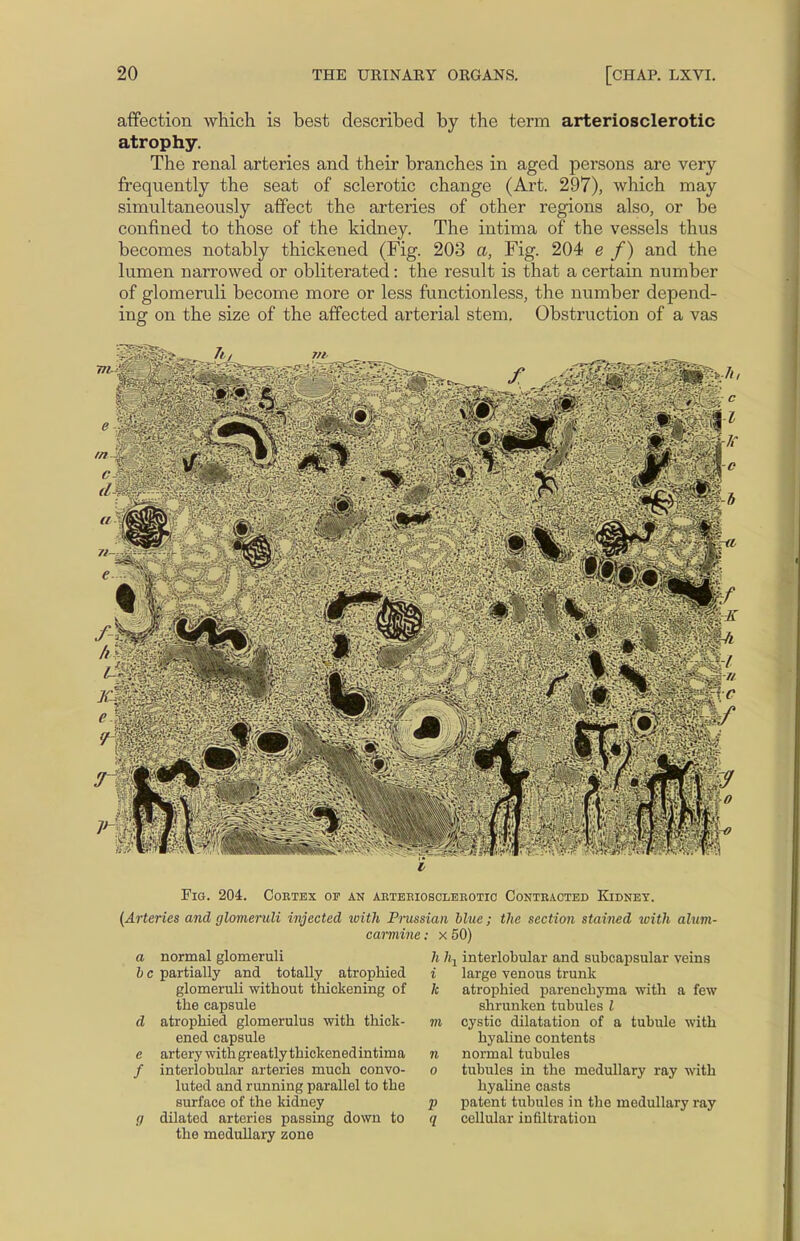 affection which is best described by the term arteriosclerotic atrophy. The renal arteries and their branches in aged persons are very frequently the seat of sclerotic change (Art. 297), which may simultaneously affect the arteries of other regions also, or be confined to those of the kidney. The intima of the vessels thus becomes notably thickened (Fig. 203 a, Fig. 204 e f) and the lumen narrowed or obliterated: the result is that a certain number of glomeruli become more or less functionless, the number depend- ing on the size of the affected arterial stem. Obstruction of a vas 7i, Fig. 204. Cortex op an arteriosclerotic Contracted Kidney. (Arteries and glomeruli injected with Prussian blue; the section stained with alnvi- carmine: x 50) a normal glomeruli h hy interlobular and subcapsular veins b c partially and totally atrophied i large venous trunk glomeruli without thickening of k atrophied parenchyma with a few the capsule shrunken tubules I d atrophied glomerulus with thick- m cystic dilatation of a tubule with ened capsule hyaline contents e artery withgreatlythickenedintima n normal tubules / interlobular arteries much convo- o tubules in the medullary ray with luted and running parallel to the hyaline casts surface of the kidney p patent tubules in the medullary ray g dilated arteries passing down to q cellular infiltration the medullary zone