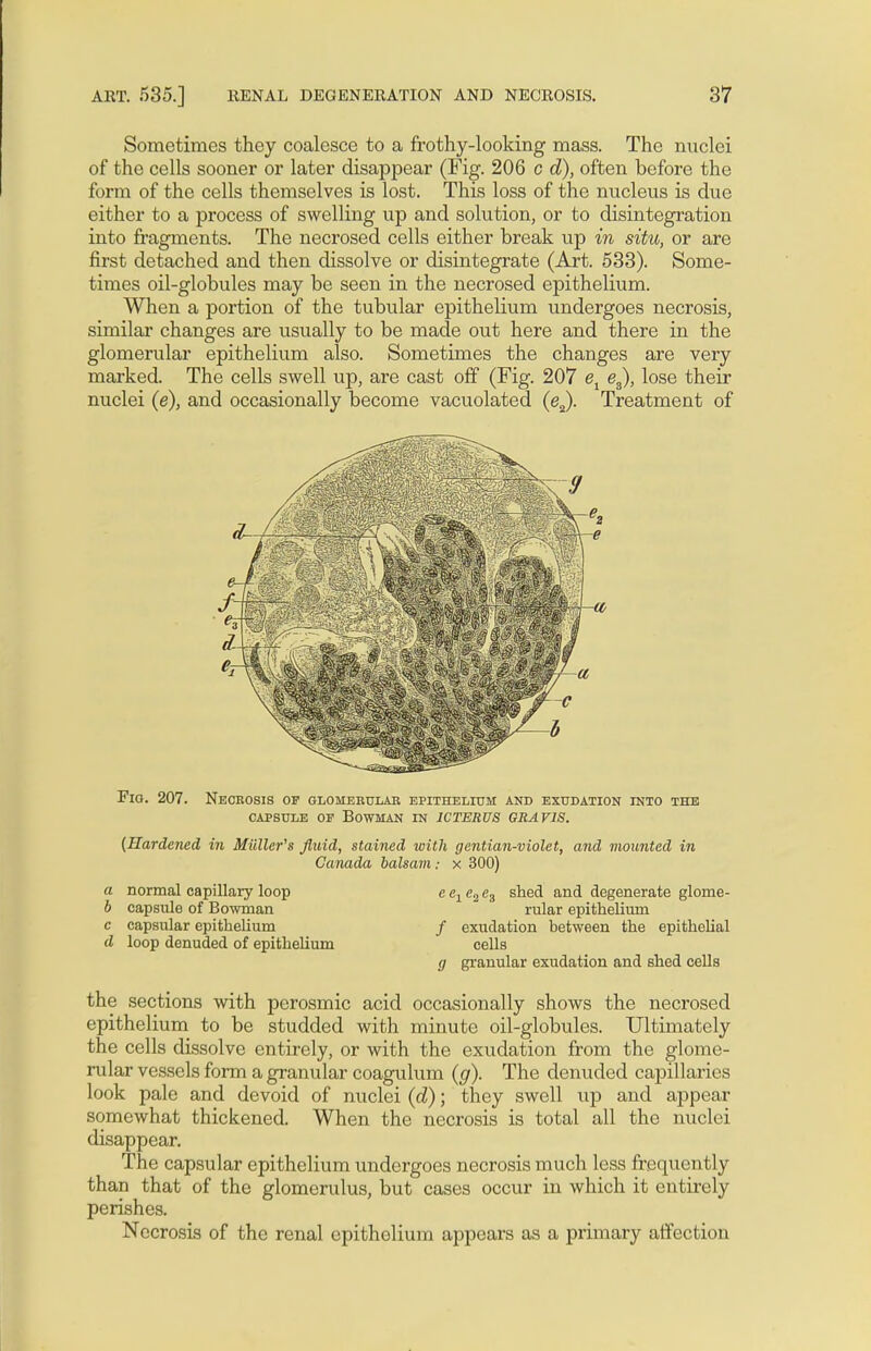 Sometimes they coalesce to a frothy-looking mass. The nuclei of the cells sooner or later disappear (Fig. 206 c d), often before the form of the cells themselves is lost. This loss of the nucleus is due either to a process of swelling up and solution, or to disintegration into fragments. The necrosed cells either break up in situ, or are first detached and then dissolve or disintegrate (Art. 533). Some- times oil-globules may be seen in the necrosed epithelium. When a portion of the tubular epithelium undergoes necrosis, similar changes are usually to be made out here and there in the glomerular epithelium also. Sometimes the changes are very marked. The cells swell up, are cast off (Fig. 207 e1 e3), lose their nuclei (e), and occasionally become vacuolated (e2). Treatment of Fio. 207. Necrosis or glomerular epithelium and exudation into the capsule of Bowman in icterus gravis. {Hardened in Mutter's fluid, stained with gentian-violet, and mounted in Canada balsam : x 300) a normal capillary loop b capsule of Bowman c capsular epithelium d loop denuded of epithelium e e1 e2 e3 shed and degenerate glome- rular epithelium / exudation between the epithelial cells g granular exudation and shed cells the sections with perosmic acid occasionally shows the necrosed epithelium to be studded with minute oil-globules. Ultimately the cells dissolve entirely, or with the exudation from the glome- rular vessels form a granular coagulum (g). The denuded capillaries look pale and devoid of nuclei (d); they swell up and appear somewhat thickened. When the necrosis is total all the nuclei disappear. The capsular epithelium undergoes necrosis much less frequently than that of the glomerulus, but cases occur in which it entirely perishes. Necrosis of the renal epithelium appears as a primary affection