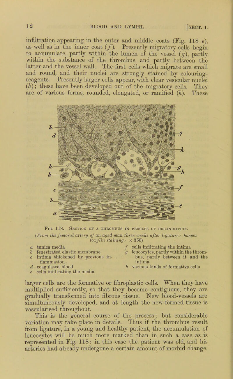 infiltration appearing in the outer and middle coats (Fig. 118 e), as well as in the inner coat (/). Presently migratoiy cells begin to accumulate, partly within the lumen of the vessel {g), partly within the substance of the thrombus, and partly between the latter and the vessel-wall. The first cells which migrate are small and round, and their nuclei are strongly stained by colouring- reagents. Presently larger cells appear, with clear vesicular nuclei (A); these have been developed out of the migratory cells. They are of various forms, rounded, elongated, or ramified (A). These Fig. 118. Section of a thrombus in process of organisation. (From the femoral artery of an aged man three weeks after ligature: haema- toxylin staining: x 350) a tunica media b fenestrated elastic membrane c intima thickened by previous in- flammation d coagulated blood e cells infiltrating the media / cells infiltrating the intima g leucocytes, partly withia the throm- bus, partly between it and the intima h various kinds of formative cells larger cells are the formative or fibroplastic cells. When they have multiplied sufficiently, so that they become contiguous, they are gradually transformed into fibrous tissue. New blood-vessels are simultaneously developed, and at length the new-formed tissue is vascularised throughout. This is the general course of the process; but considerable variation may take place in details. Thus if the thrombus result from ligature, in a young and healthy patient, the accumulation of leucocytes will be much more marked than in such a case as is represented in Fig. 118: in this case the patient was old, and his arteries had already undergone a certain amount of morbid change.