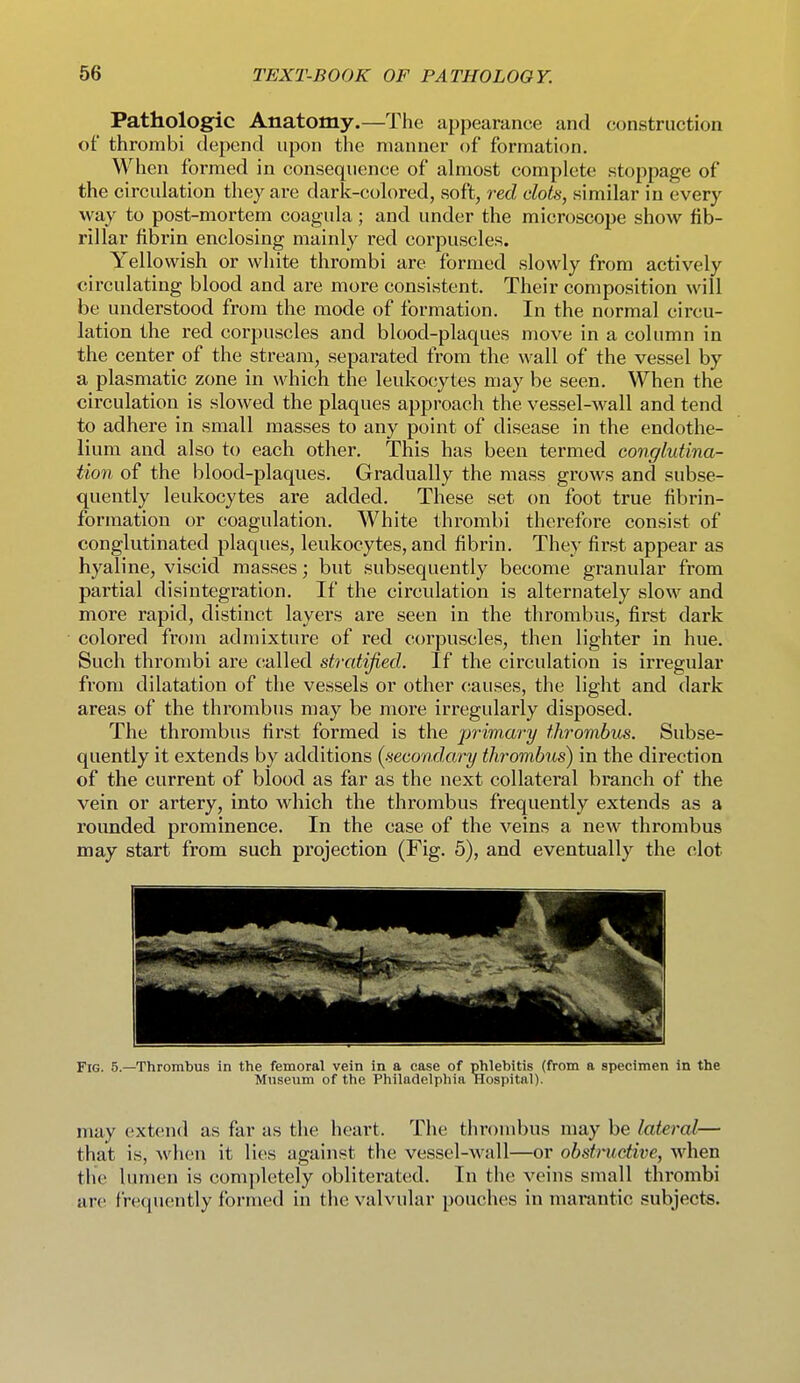Pathologic Anatomy.—The appearance and construction of thrombi depend upon the manner of formation. When formed in consequence of almost complete stoppage of the circulation they are dark-colored, soft, red clots, similar in every way to post-mortem coagula ; and under the microscope show fib- rillar fibrin enclosing mainly red corpuscles. Yellowish or white thrombi are formed slowly from actively circulating blood and are more consistent. Their composition will be understood from the mode of formation. In the normal circu- lation the red corpuscles and blood-plaques move in a column in the center of the stream, separated from the wall of the vessel by a plasmatic zone in which the leukocytes may be seen. When the circulation is slowed the plaques approach the vessel-wall and tend to adhere in small masses to any point of disease in the endothe- lium and also to each other. This has been termed conglutina- tion of the blood-plaques. Gradually the mass grows and subse- quently leukocytes are added. These set on foot true fibrin- formation or coagulation. White thrombi therefore consist of conglutinated plaques, leukocytes, and fibrin. They first appear as hyaline, viscid masses; but subsequently become granular from partial disintegration. If the circulation is alternately slow and more rapid, distinct layers are seen in the thrombus, first dark colored from admixture of red corpuscles, then lighter in hue. Such thrombi are (tailed stratified. If the circulation is irregular from dilatation of the vessels or other causes, the light and dark areas of the thrombus may be more irregularly disposed. The thrombus first formed is the ■primary thrombus. Subse- quently it extends by additions (secondary thrombus) in the direction of the current of blood as far as the next collateral branch of the vein or artery, into which the thrombus frequently extends as a rounded prominence. In the case of the veins a new thrombus may start from such projection (Fig. 5), and eventually the clot Fig. 5.—Thrombus in the femoral vein in a case of phlebitis (from a specimen in the Museum of the Philadelphia Hospital). may extend as far as the heart. The thrombus may be lateral— that is, Avhen it lies against the vessel-wall—or obstructive, when the lumen is completely obliterated. In the veins small thrombi are frequently formed in the valvular pouches in marantic subjects.