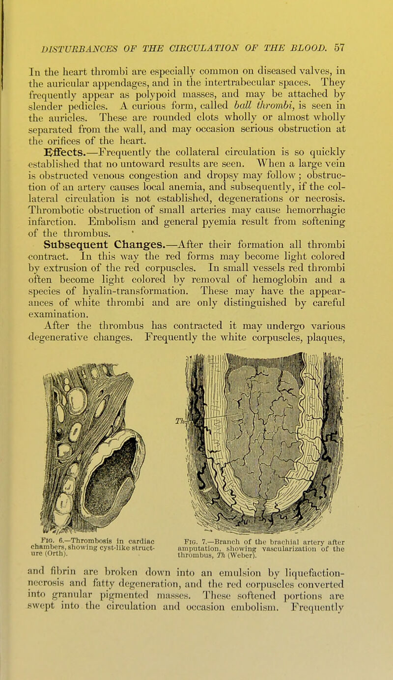 In the heart thrombi are especially common on diseased valves, in the auricular appendages, and in the intei'trabecular spaces. They frequently appear as polypoid masses, and may be attached by slender pedicles. A curious form, called ball thrombi, is seen in the auricles. These are rounded clots wholly or almost wholly separated from the wall, and may occasion serious obstruction at the orifices of the heart. Effects.—Frequently the collateral circulation is so quickly established that no untoward results are seen. When a large vein is obstructed venous congestion and dropsy may follow; obstruc- tion of an artery causes local anemia, and subsequently, if the col- lateral circulation is not established, degenerations or necrosis. Thrombotic obstruction of small arteries may cause hemorrhagic infarction. Embolism and general pyemia result from softening of the thrombus. Subsequent Changes.—After their formation all thrombi contract. In this way the red forms may become light colored by extrusion of the red corpuscles. In small vessels red thrombi often become light colored by removal of hemoglobin and a species of hyalin-transformation. These may have the appeai- auces of white thrombi and are only distinguished by careful examination. After the thrombus has contracted it may undergo various degenerative changes. Frequently the white corpuscles, plaques, Fig. 6—Thrombosis in cardiac Fig. 7.—Brancli of the brachial artery after chambers, showing cyst-lilte struct- amputation, showinp: vascularization of the ure (Orth). thrombus, Th (Weber). and fibrin are broken down into an emulsion by liquefaction- necrosis and fatty degeneration, and the red corpuscles converted into granular pigmented masses. These softened portions are swept into the circulation and occasion embolism. Frequently