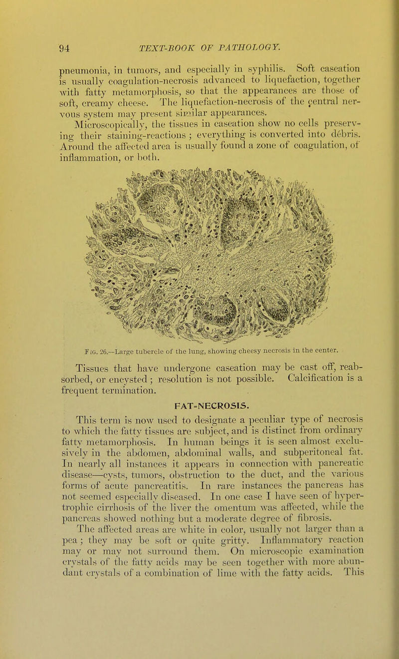 pneumonia, in tumors, and especially in syphilis. Soft caseation is usually coagulation-necrosis advanced to liquefaction, together with fatty metanittrphosis, so that the appearances are those of soft, ci-eamy cheese. The liquefaction-necrosis of the central ner- vous system may present sii?.iilar appearances. Microscopically, the tissues in caseation show no cells preserv- ing their staining-reactions ; everything is converted into debris. Around the affecfed area is usually found a zone of coagulation, of inflammation, or l)oth. FIG. 26.—Large tubercle of the lung, showing cheesy necrosis in the center. Tissues that have undergone caseation may be cast off, reab- sorbed, or encysted ; resolution is not possible. Calcification is a frequent termination. FAT=NECROSIS. This term is now used to designate a peculiar type of necrosis to which the fatty tissues are subject, and is distinct from ordinary fatty metamorphosis. In human beings it is seen almost exclu- sively in the abdomen, abdominal walls, and subperitoneal fat. In nearly all instances it appears in connection Avith pancreatic disease—cysts, tumors, obstruction to the duct, and the various forms of acute pancreatitis. In rare instances the pancreas has not seemed especially diseased. In one case I have seen of hyper- trophic cirrhosis of the liver the omentum was affected, while the pancreas showed nothing but a moderate degree of fibrosis. The affected areas are white in color, usually not larger than a pea ; they may be soft or quite gritty. Inflammatory reaction may or may not surround them. On microscopic examination crystals of the fatty acids may be seen together with more abun- dant crystals of a combination of lime with the fatty acids. This