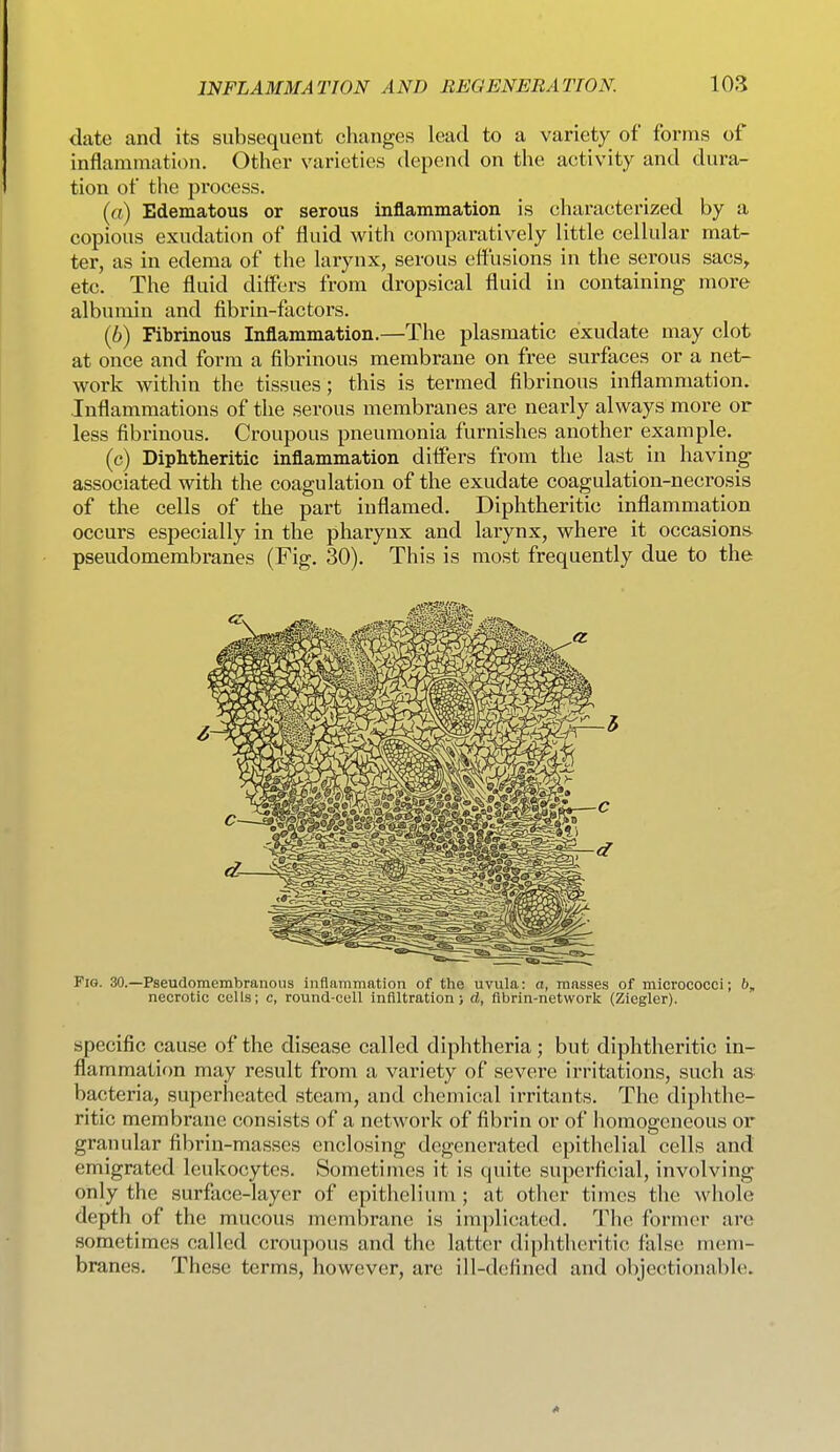 date and its subsequent changes lead to a variety of forms of inflammation. Other varieties depend on the activity and dura- tion of the process. (a) Edematous or serous inflammation is characterized by a copious exudation of fluid with comparatively little cellular mat- ter, as in edema of the larynx, serous effusions in the serous sacs, etc. The fluid differs from dropsical fluid in containing more albumin and fibrin-factors. (6) Fibrinous Inflammation.—The plasmatic exudate may clot at once and form a fibrinous membrane on free surfaces or a net- work within the tissues; this is termed fibrinous inflammation. Inflammations of the serous membranes are nearly always more or less fibrinous. Croupous pneumonia furnishes another example. (c) Diphtheritic inflammation differs from the last in having associated with the coagulation of the exudate coagulation-necrosis of the cells of the part inflamed. Diphtheritic inflammation occurs especially in the pharynx and larynx, where it occasions pseudomembranes (Fig. 30). This is most frequently due to the Fig. 30.—Pseudomembranous inflammation of the uvula: a, masses of micrococci; b, necrotic cells; c, round-cell infiltration; d, fibrin-network (Ziegler). specific cause of the disease called diphtheria; but diphtheritic in- flammation may result from a variety of severe irritations, such as bacteria, superheated steam, and chemical irritants. The diphthe- ritic membrane consists of a network of fibrin or of homogeneous or granular fibrin-masses enclosing degenerated epithelial cells and emigrated leukocytes. Sometimes it is quite supei'ficial, involving only the surface-layer of epithelium ; at other times the wliole depth of the mucous membrane is implicated. The former are sometimes called croupous and the latter diplitheritic false mem- branes. These terms, however, are ill-defined and objectionable.