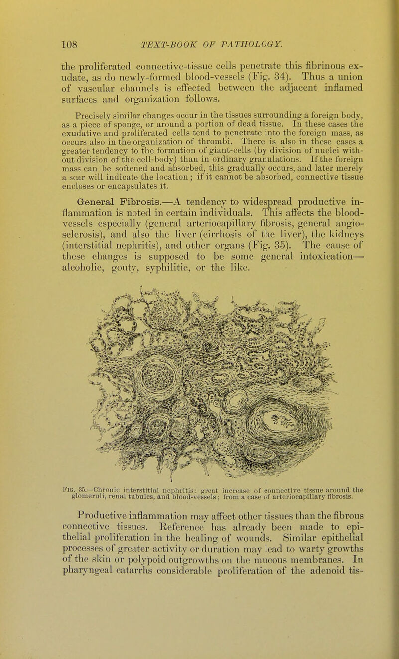 tlie proliferated couiiective-tissue cells penetrate this fibrinous ex- udate, as do newly-formed blood-vessels (Fig. 34). Thus a union of vascular channels is effected between the adjacent inflamed surfaces and organization follows. Precisely similar changes occur in the tissues surrounding a foreign body, as a piece of sponge, or around a portion of dead tissue. In these cases the exudative and proliferated cells tend to penetrate into the foreign mass, as occurs also in the organization of thrombi. There is also in these cases a greater tendency to the formation of giant-cells (by division of nuclei with- out division of the cell-body) than in ordinary granulations. If the foreign mass can be softened and absorbed, this gradually occurs, and later merely a scar will indicate the location ; if it cannot be absorbed, connective tissue encloses or encapsulates it. General Fibrosis.—A tendency to widespread productive in- flammation is noted in certain individuals. This affects the blood- vessels especially (general arteriocapillary fibrosis, general angio- sclerosis), and also the liver (cirrhosis of the liver), the kidneys (interstitial nephritis), and other organs (Fig. 35). The cause of these changes is supposed to be some general intoxication— alcoholic, gouty, syphilitic, or the like. Fig. 35.—Chronic interstitial nephritis: nv*Mt increase of connective tissue around the glomeruli, renal tubules, and Dlood-vessels; from a case of arteriocapillary fibrosis. Productive inflammation may affect other tissues than the fibrous connective tissues. Reference has already been made to epi- thelial proliferation in the healing of wounds. Similar epithelial processes of greater activity or duration may lead to warty growths of the skin or polypoid outgrowths on the mucous membranes. In pharyngeal catarrhs considerable proliferation of the adenoid tis-
