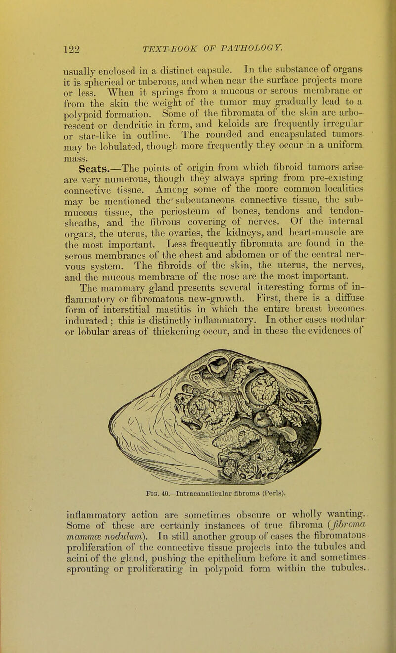 usually enclosed in a distinct capsule. In the substance of organs it is spherical or tuberous, and when near the surface projects more or less. When it springs from a mucous or serous membrane or from the skin the weight of the timior may gradually lead to a polypoid formation. Some of the fibromata of the skin are arbo- rescent or dendritic in form, and keloids are frequently irregular or star-like in outline. The rounded and encapsulated tumors may be lobulated, though more frequently they occur in a uniform mass. Seats.—The points of origin from which fibroid tumors arise are very numerous, thoxigh they always spring from pre-existing connective tissue. Among some of the more common localities may be mentioned the' subcutaneous connective tissue, the sub- mucous tissue, the periosteum of bones, tendons and tendon- sheaths, and the fibrous covering of nerves. Of the internal organs, the uterus, the ovaries, the kidneys, and heart-muscle are the most important. Less frequently fibromata are found in the serous membranes of the chest and abdomen or of the central ner- vous system. The fibroids of the skin, the uterus, the nerves, and the mucous membrane of the nose are the most important. The mammary gland presents several interesting forms of in- flammatory or fibromatous new-growth. First, there is a diffuse form of interstitial mastitis in which the entire breast becomes indurated ; this is distinctly inflammatory. In other cases nodular or lobular areas of thickening occur, and in these the evidences of Pig. 40.—Intracanalicular fibroma (Perls). inflammatory action are sometimes obscure or wholly wanting. Some of these are certainly instances of true fibroma ( fibroma mammcB nodulum). In still another group of cases the fibromatous proliferation of the connective tissue projects into the tubules and acini of the gland, pushing the epithelium before it and sometimes sprouting or proliferating in polypoid form within the tubules.