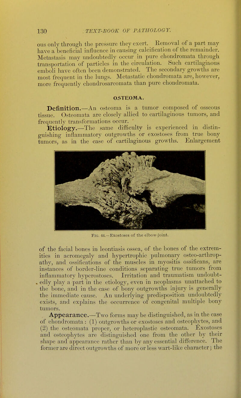 ous only through the pressure they exert. Removal of a part may have a beneficial influence in causing calcification of the remainder. Metastasis may undoubtedly occur in pure chondromata through transportation of particles in the circulation. Such cartilaginous emboli have often been demonstrated. The secondary growtlis are most frequent in the lungs. Metastatic chondromata are, however, more frequently chondrosarcomata than pure chondromata. OSTEOMA. Definition.—An osteoma is a tumor composed of osseous tissue. Osteomata are closely allied to cartilaginous tumors, and frequently transformations occur. !Btiology.—The same difficulty is experienced in distin- guishing inflammatory outgrowths or exostoses from true bony tumors, as in the case of cartilaginous growths. Enlargement Fig. 44.—Exostoses of the elbow-joiut. of the facial bones in leontiasis ossea, of the bones of the extrem- ities in acromegaly and hypertrophic pulmonary osteo-arthrop- athy, and ossifications of the muscles in myositis ossificans, are instances of border-line conditions separating true tumors from inflammatory hyperostoses. Irritation and traumatism undoubt- . edly play a part in the etiology, even in neoplasms unattached to the bone, and in the case of bony outgrowths injury is generally the immediate cause. An underlying predisposition undoubtedly exists, and explains the occurrence of congenital multiple bony tumors. . Appearance.—Two forms may be distinguished, as in the case of chondromata : (1) outgrowths or exostoses and osteophytes, and (2) the osteomata proper, or heteroplastic osteomata. Exostoses and osteophytes are distinguished one from the otlier by their shape and appearance rather than by any essential difference. The former are direct outgrowths of more or less wart-like character; the