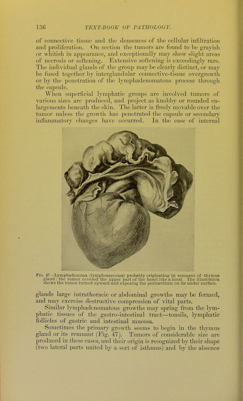 of connective tissue and the deuseness of the celhilar infiltration and proliferation. On section the tumors are found to be grayish or whitish in ap{)earance, and exceptionally may show slight areas of necrosis or softening. Extensive softening is exceedingly rare. The individual glands of the group may be clearly distinct, or may be fused together by interglandular connective-tissue overgrowth or by the penetration of the lymphadenomatous process through the capsule. When superficial lymphatic groups are involved tumors of various sizes are produced, and project as knobby or rounded en- largements beneath the skin. The latter is freely movable over the tumor unless the growth has penetrated the (lapsule or secondary inflammatory changes have occurred. lu the case of internal Fig. 47—Lymphadenoma (lymphosarcoma) probably originating in remnant of thymus gland : the tumor covered the upper part of the heart like a hood. The illustration shows the tumor turned upward and exposing the pericardium on its under surface. glands large intrathoracic or abdominal growths may be formed, and may exercise destructive compression of vital parts. Similar lymphadenomatous growths may spring from the lym- phatic tissues of the gastro-intestinal tract—tonsils, lymphatic follicles of gastric and intestinal mucosa. Sometimes the primary growth seems to begin in the thymus gland or its remnant (Fig, 47). Tumors of considerable size are produced in these cases, and their origin is recognized by their shape (two lateral parts united b.v a sort of isthmus) and by the absence