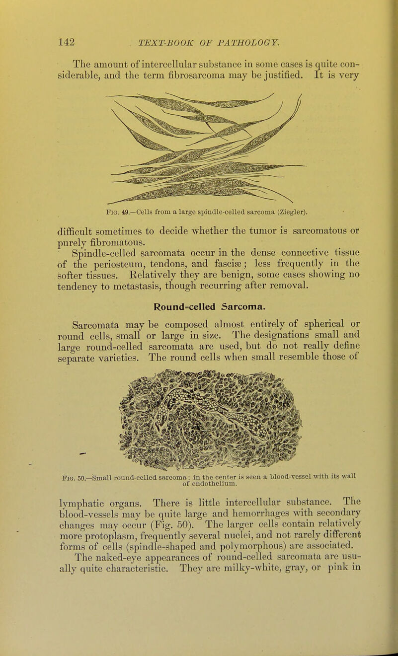 The amount of intei'cellular substance in some cases is quite con- siderable, and the term fibrosarcoma may be justified. It is very Fig. 49.—Cells from a large spindle-celled sarcoma (Zlegler). difficult sometimes to decide whether the tumor is sarcomatous or purely fibromatous. Spindle-celled sarcomata occur in the dense connective tissue of the periosteum, tendons, and fasciae; less frequently in the softer tissues. Relatively they are benign, some cases showing no tendency to metastasis, though recurring after removal. Round-celled Sarcoma. Sarcomata may be composed almost entirely of spherical or round cells, small or large in size. The designations small and large round-celled sarcomata are used, but do not really define separate varieties. The round cells when small resemble those of Fig. 50.—Small round-celled sarcoma: in the center is seen a blood-vessel with its wall of endothelium. lymphatic organs. There is little intercellular substance. The blood-vessels may be quite large and hemorrhages with secondary changes may occur (Fig. 50). The larger cells contain relatively more protoplasm, frequently several nuclei, and not rarely different forms of cells (spindle-shaped and polymorphous) are associated. The naked-eye appearances of round-celled sarcomata are usu- ally quite characteristic. They are milky-white, gi*ay, or pink in