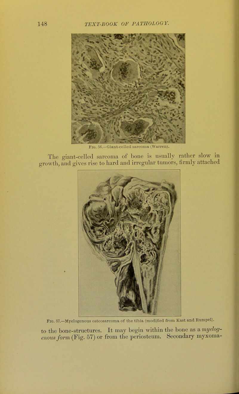 Fig. 57.—Myelogenous osteosarcoma of the tibia (modified from Kast and Rumpel). to the bone-structures. It may begin within tlie bone as a myelog- enous Jorm (Fig. 57) or from the periosteum. Secondary myxoma-