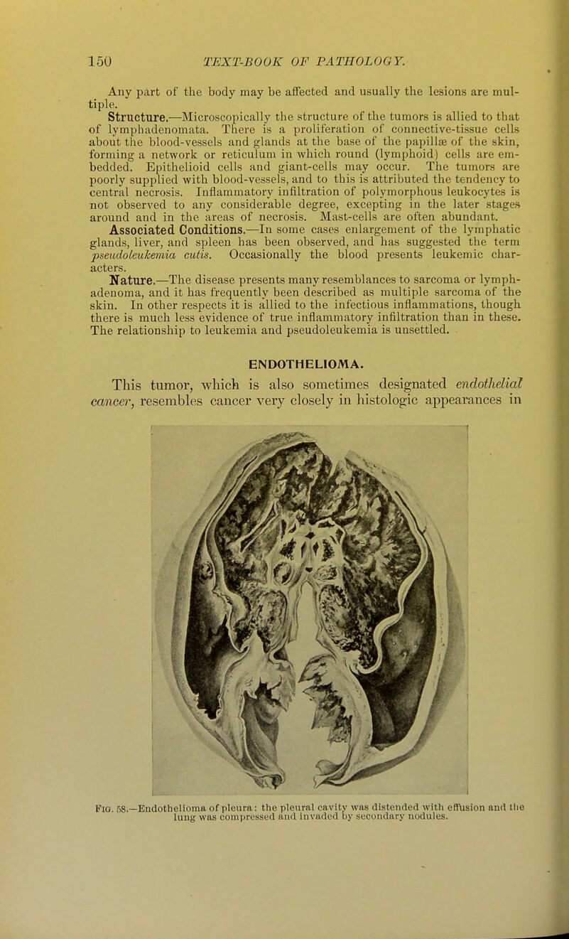 Any part of the body may be affected and usually the lesions are mul- tiple. Structure.—Microscopically the structure of the tumors is allied to that of lymphadenomata. There is a proliferation of connective-tissue cells about the blood-vessels and glands at the base of the papillae of the skin, forming a network or reticulum in which round (lymphoid) cells are em- bedded. Epithelioid cells and giant-cells may occur. The tumors are poorly supplied with blood-vessels, and to this is attributed the tendency to central necrosis. Inflammatory infiltration of polymorphous leukocytes is not observed to any considerable degree, excepting in the later stages around and in the areas of necrosis. Mast-cells are often abundant. Associated Conditions.—In some cases enlargement of the lymphatic glands, liver, and spleen has been observed, and has suggested the term pseudoleukemia cutis. Occasionally the blood presents leukemic char- acters. Nature.—The disease presents many resemblances to sarcoma or lymph- adenoma, and it has frequently been described as multiple sarcoma of the skin. In other respects it is allied to the infectious inflammations, though there is much less evidence of true inflammatory infiltration than in these. The relationship to leukemia and pseudoleukemia is unsettled. ENDOTHELIOMA. This tumor, which is also sometimes designated endothelial cancer, resembles cancer very closely in histologic appearances in Pia. f)8.—Endothelioma of pleura: the pleural cavity was distended with eflfUsion and the lung was compressed and invaded by secondary nodules.