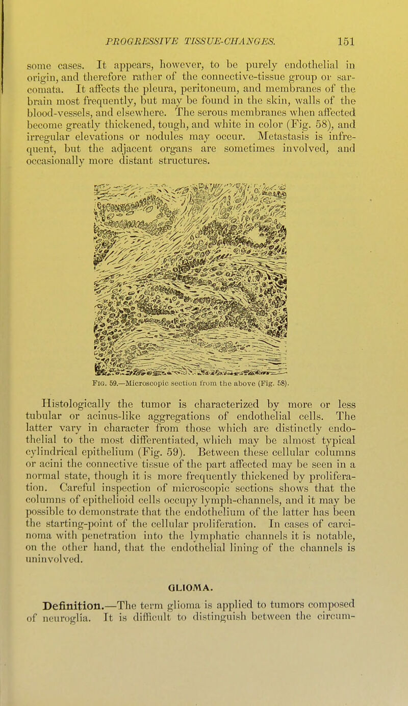 some cases. It appears, however, to be purely endothelial in origin, and therefore rather of the connective-tissue group or sar- coiiuita. It affects the pleura, peritoneum, and membranes of the brain most frequently, but may be found in the skin, walls of the blood-vessels, and elsewhere. The serous membranes when affected become greatly thickened, tough, and white in color (Fig. 58), and irregular elevations or nodules may occur. Metastasis is infre- quent, but the adjacent organs are sometimes involved, and occasionally more distant structures. Fig. 59.—Microscopic sectiuu from the above (Fig. 58). Histologically the tumor is characterized by more or less tubular or acinus-like aggregations of endothelial cells. The latter vary in character from those which are distinctly endo- thelial to the most differentiated, which may be almost typical cylindrical epithelium (Fig. 59). Between these cellular columns or acini the connective tissue of the part affected may be seen in a normal state, though it is more frequently thickened by prolifera- tion. Careful inspection of microscopic sections shows that the columns of epithelioid cells 0(!cupy lymph-channels, and it may be possible to demonstrate that the endothelium of the latter has been the starting-point of the cellular proliferation. In cases of carci- noma with penetration into the lymphatic channels it is notable, on the other hand, that the endothelial lining of the channels is uninvolved. GLIOMA. Definition.—The term glioma is applied to tumors composed of neuroglia. It is difficult to distinguish between the circum-