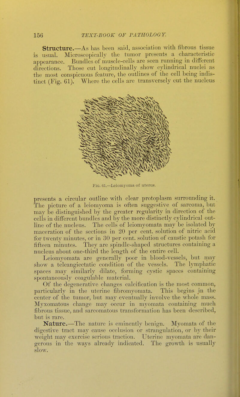 Structure.—As has been said, association Avith fibrous tissue is usual. Microscopically the tumor presents a characteristic appearance. Bundles of muscle-cells are seen running in different directions. Those cut longitudinally shoAV cylindrical nuclei as the most conspicuous feature, the outlines of the cell l^eing indis- tinct (Fig. 61). Where the cells are transversely cut the nucleus Fig. 61.—Leiomyoma of uterus. presents a circular outline with clear protoplasm surrounding it. The picture of a leiomyoma is often suggestive of sarcoma, but may be distinguished by the greater regularity in direction of the cells in diffei-ent bundles and by the more distinctly cylindrical out- line of the nucleus. The cells of leiomyomata may be isolated by maceration of the sections in 20 per cent, solution of nitric acid for twenty minutes, or in 30 per cent, solution of caustic potash for fifteen minutes. They are spindle-shaped structures containing a nucleus about one-third the length of the entire cell. Leiomyomata are generally poor in blood-vessels, but may show a teleangiectatic condition of the vessels. The lymphatic spaces may similarly dilate, forming cystic spaces containing spontaneously coagulable material. Of the degenerative changes calcification is the most common, particularly in the uterine fibromyomata. This begins in the center of the tumor, but may eventually involve the whole mass. Myxomatous change may occur in myomata containing ituich fibrous tissue, and sarcomatous transformation has been described, but is rare. Nature.—The nature is eminently benign. Myomata of the digestive tract may cause occlusion or strangulation, or by their weight may exercise serious traction. Uterine myomata are dan- gerous in the ways already indicated. The growth is usually slow.