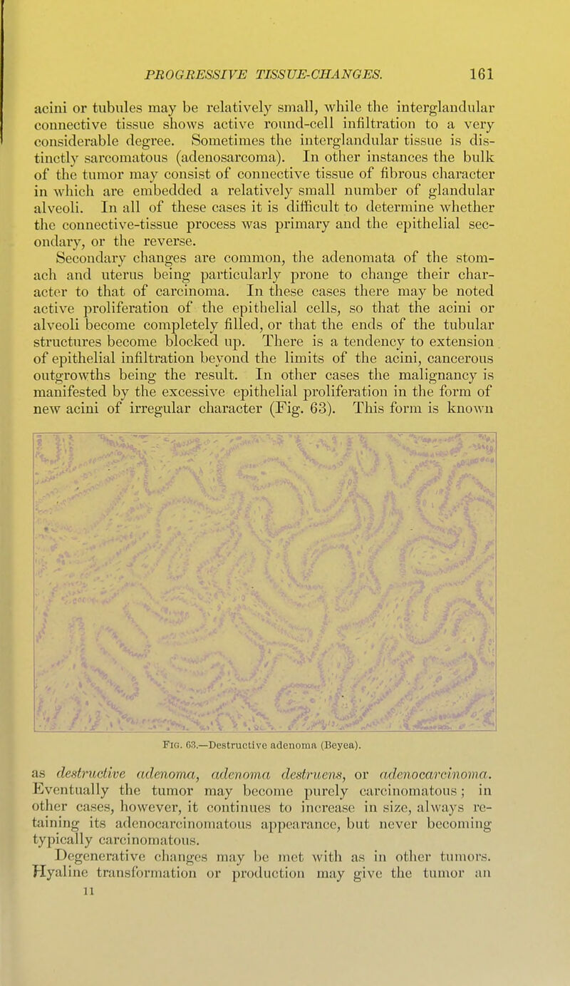 acini or tubules may be relatively small, while the interglandular connective tissue shows active round-cell infiltration to a very considerable degree. Sometimes the interglandular tissue is dis- tinctly sarcomatous (adenosarcoma). In other instances the bulk of the tumor may consist of connective tissue of fibrous character in which are embedded a relatively small number of glandular alveoli. In all of these cases it is difficult to determine whether the connective-tissue process was primary and the epithelial sec- ondary, or the reverse. Secondary changes are common, tlie adenomata of the stom- ach and uterus being particularly prone to change their char- acter to that of carcinoma. In these cases there may be noted active proliferation of the epithelial cells, so that the acini or alveoli become completely filled, or that the ends of the tubular structures become blocked up. There is a tendency to extension of epithelial infiltration beyond the limits of the acini, cancerous outgrowths being the result. In other cases the malignancy is manifested by the excessive epithelial proliferation in the form of new acini of irregular character (Fig. 63). This form is known Fig. 63.—Destructive adenoma (Beyea). as destructive adenoma, adenoma destruens, or adenocarcinoma. Eventually the tumor may become purely carcinomatous; in other cases, however, it continues to increase in size, always re- taining its adenocarcinomatous appearance, but never becoming typically carcinomatous. Degenerative changes may be met with as in other tumors. Hyaline transformation or production may give the tumor an 11