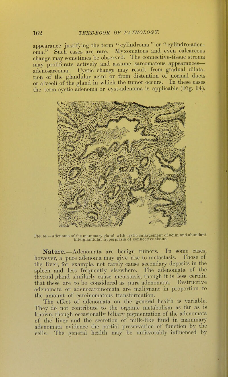 appearance justifying the term cylindroma or cylindro-aden- oma. Such cases are rare. Myxomatous and even calcareous change may sometimes be observed. The connective-tissue stroma may proliferate actively and assume sarcomatous appearances— adenosarcoma. Cystic change may result from gradual dilata- tion of the glandular acini or from distention of normal ducts or alveoli of the gland in which the tumor occurs. In these cases the term cystic adenoma or cyst-adenoma is applicable (Fig. 64). Fig. 64.—Adenoma of tlie mammary gland, with cj'stic enlargement of acini and abundant interglandular hyperplasia of connective tissue. Nature.—Adenomata are benign tumors. In some cases, however, a pure adenoma may give rise to metastasis. Those ol the liver, for example, not rarely cause secondary deposits in the spleen and less frequently elsewhere. The adenomata of the thyroid gland similarly cause metastasis, though it is less certain that these are to be considered as jiui'e adenomata. Destructive adenomata or adenocarcinomata are malignant in proportion to the amount of carcinomatous transformation. The effect of adenomata on the general health is variable. They do not contribute to the oi-ganic metabolism as far as is known, though occasionally biliary pigmentation of the adenomata of the liver and the secretion of milk-like ffuid in mammary adenomata evidence the partial preservation of function by the cells. The general health may be unfavorably influenced by