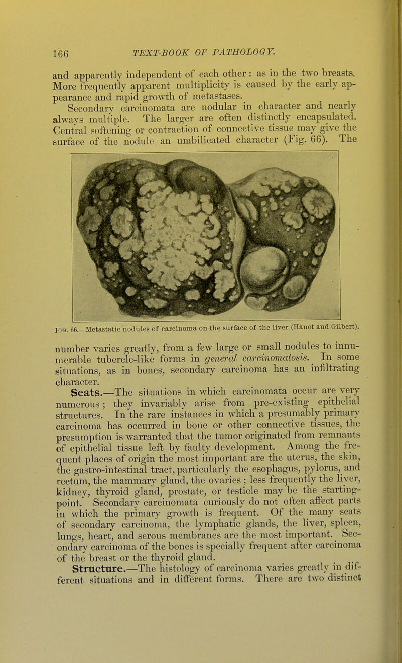 and apparently independent of each other: as in the two breasts. More frequently apparent multiplicity is caused by the early ap- pearance and rapid growth of metastases. Secondary carcinomata are nodular in character and nearly always multiple. The larger are often distinctly encapsulated. Central softening or contraction of connective tissue may give the surface of the nodule an umbilicated character (Fig. 66). The FIG. 66.—Metastatic nodules of carcinoma on the surface of the liver (Hanot and Gilbert). number varies greatly, from a few large or small nodules to innu- merable tubercle-like forms in general carcinomatosis.^ In some situations, as in bones, secondary carcinoma has an infiltrating character. Seats.—The situations in which carcinomata occur are very numerous; they invariably arise from . pre-existing epithelial structures. In the rare instances in which a presumably primar}-- carcinoma has occurred in bone or other connective tissues, the presumption is warranted that the tumor originated from remnants of epithelial tissue left by faulty development. Among the fre- quent places of origin the most important are the uterus, the skin, the gastro-intestinal tract, particularly the esophagus, pylorus, and rectum, the mammary gland, the ovaries ; less frequently the liver, kidney, thyroid gland, prostate, or testicle may be the starting- point. Secondary carcinomata curiously do not often affect parts in which the primary growth is frequent. Of the many seats of secondary carcinoma, the lymphatic glands, the liver, spleen, lungs, heart, and serous membranes are the most important. ^ Sec- ondary carcinoma of the bones is specially frequent after carcinoma of the breast or the thyroid gland. Structure.—The histology of carcinoma varies greatly in dif- ferent situations and in different forms. There are two distinct