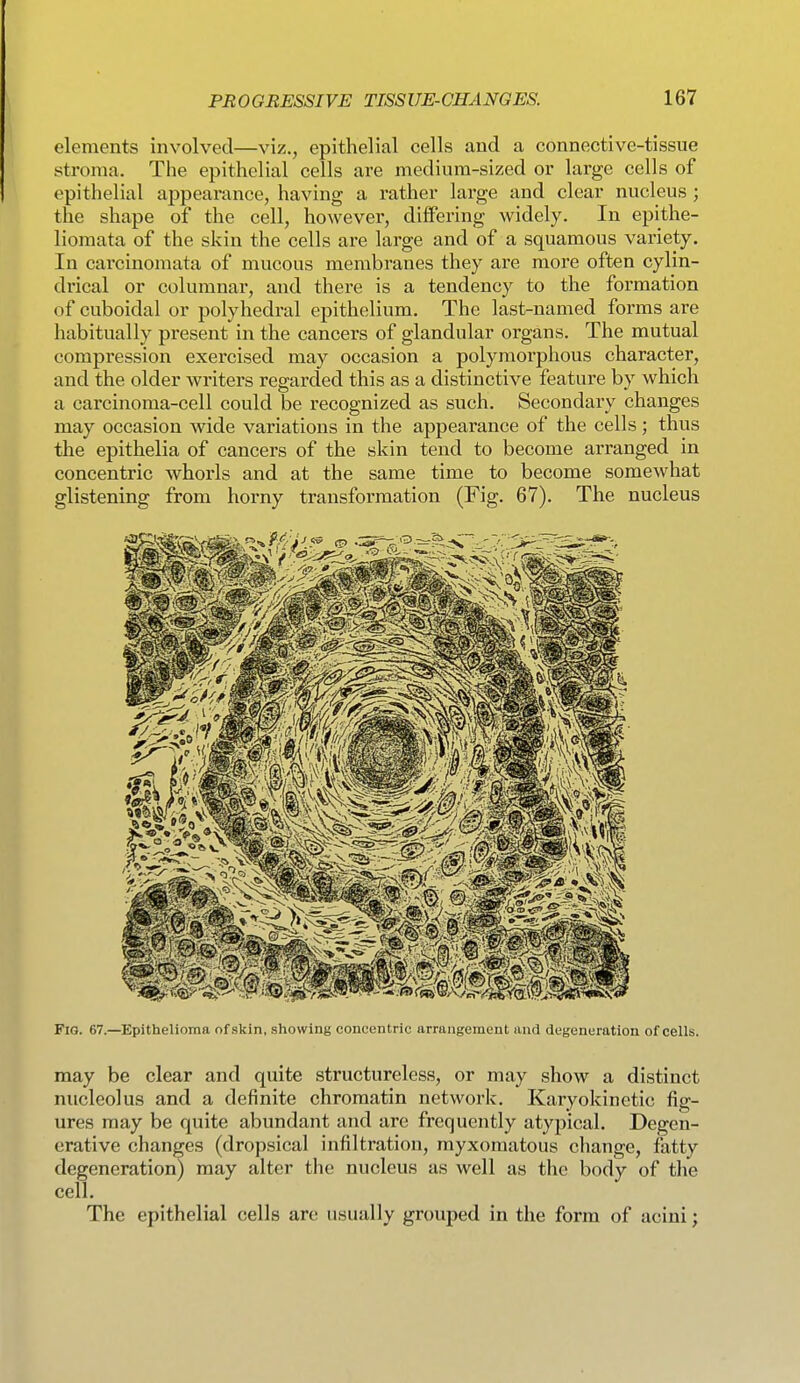 elements involved—viz., epithelial cells and a connective-tissue stroma. The epithelial cells are medium-sized or large cells of epithelial appearance, having a rather large and clear nucleus ; the shape of the cell, however, differing widely. In epithe- liomata of the skin the cells are large and of a squamous variety. In carcinomata of mucous membranes they are more often cylin- drical or columnar, and there is a tendency to the formation of cuboidal or polyhedral epithelium. The last-named forms are habitually present in the cancers of glandular organs. The mutual compression exercised may occasion a polymorphous character, and the older writers regarded this as a distinctive feature by which a carcinoma-cell could be recognized as such. Secondary changes may occasion wide variations in the appearance of the cells; thus the epithelia of cancers of the skin tend to become arranged in concentric whorls and at the same time to become somewhat glistening from horny transformation (Fig. 67). The nucleus Fig. 67.—Epithelioma of skin, showing concentric arrangement and degeneration of cells. may be clear and quite structureless, or may show a distinct nucleolus and a definite chromatin network. Karyokinetic fig- ures may be quite abundant and are frequently atypical. Degen- erative changes (dropsical infiltration, myxomatous change, fatty degeneration) may alter the nucleus as well as the body of the cell. The epithelial cells are usually grouped in the form of acini;