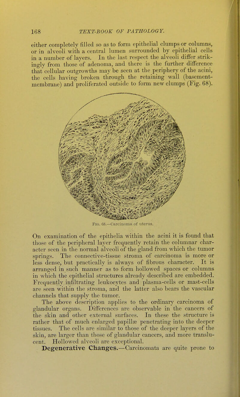 either completely filled so as to form epithelial clumps or columns, or in alveoli with a central lumen surrounded by epithelial cells in a number of layers. In the last respect the alveoli differ strik- ingly from those of adenoma, and there is the further difference that cellular outgrowths may be seen at the periphery of the acini, the cells having broken through the retaining wall (basement- membrane) and proliferated outside to form new clumps (Fig. 68). Fig. 68.—Curcinonica of uterus. On examination of the epithelia within the acini it is found that those of the peripheral layer frequently retain the columnar char- acter seen in the normal alveoli of the gland from which the tumor springs. The connective-tissue stroma of carcinoma is more or less dense, but practically is always of fibrous character. It is arranged in such manner as to form hollowed spaces or columns in which the epithelial structures already described are embedded. Frequently infiltrating leukocytes and plasma-cells or mast-cells are seen within the stroma, and the latter also bears the vascular channels that supply the tumor. The above description applies to the ordinary carcinoma of glandular organs. Differences are observable in the cancers of the skin and other external surfaces. In these the structure is rather that of much enlarged papillae penetrating into the deeper tissues. The cells are similar to those of the deeper layers of the skin, are larger than tliose of glandular cancers, and more translu- cent. Hollowed alveoli arc exceptional. Degenerative Changes.—Carcinomata are quite prone to