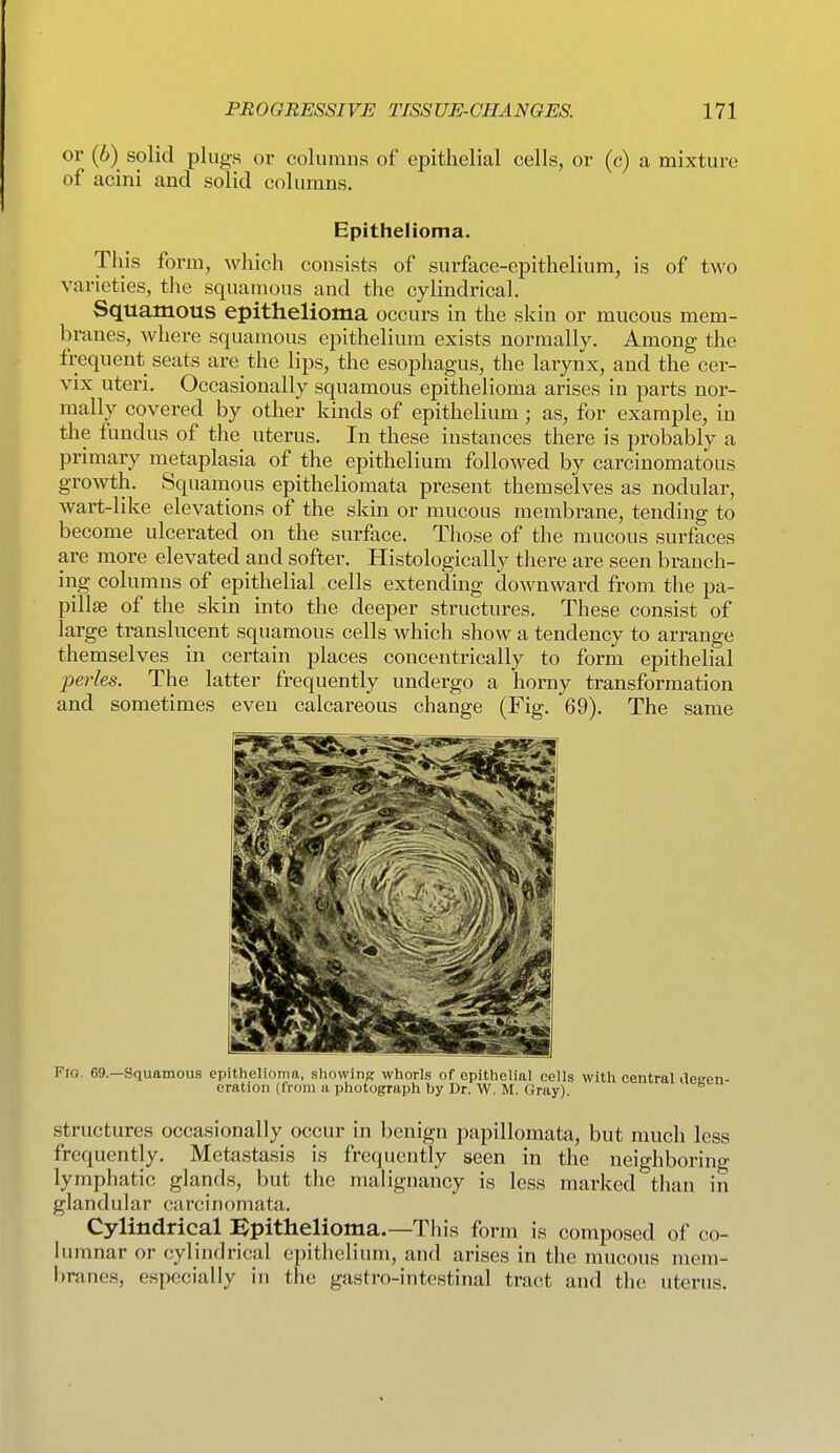 or (6) solid plugs or columns of epithelial cells, or (c) a mixture of acini and solid columns. Epithelioma. This form, which consists of surface-epithelium, is of two varieties, the squamous and the cylindrical. Squamous epithelioma occurs in the skin or mucous mem- branes, where squamous epithelium exists normally. Among the frequent seats are the lips, the esophagus, the larynx, and the cer- vix uteri. Occasionally squamous epithelioma arises in parts nor- mally covered by other kinds of epithelium; as, for example, in the fundus of the uterus. In these instances there is probably a primary metaplasia of the epithelium followed by carcinomatous growth. Squamous epitheliomata present themselves as nodular, wart-like elevations of the skin or mucous membrane, tending to become ulcerated on the surface. Those of the mucous surfaces are more elevated and softer. Histologically there are seen branch- ing columns of epithelial cells extending downward from the pa- pillse of the skin into the deeper structures. These consist of large translucent squamous cells which show a tendency to arrange themselves in certain places concentrically to form epithelial perles. The latter frequently undergo a horny transformation and sometimes even calcareous change (Fig. 69). The same structures occasionally occur in benign papillomata, but much less frequently. Metastasis is frequently seen in the neighboring lymphatic glands, but the malignancy is less marked than in glandular carcinomata. Cylindrical l^pithelioma.—This form is composed of co- lumnar or cylindrical epithelium, and arises in the mucous mem- branes, especially in the gastro-intestinal tract and the uterus.