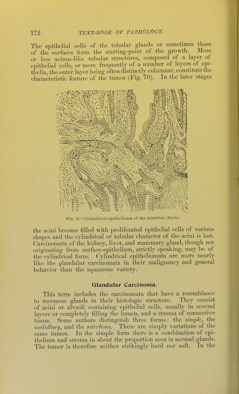 The epithelial cells of the tubular glands or sometimes those of the surfaces form the starting-point of the growth. More or less acinus-like tubular structures, composed of a layer of epithelial cells, or more frequently of a number of layers of epi- thelia, the outer layer being often distinctly columnar, constitute the characteristic feature of the tumor (Fig. 70). In the later stages Fig. 70.—Cylindrical epithelioma of the intestine (Perls). the acini become filled with proliferated epithelial cells of various shapes and the cylindrical or tubular character of the acini is lost. Carcinomata of the kidney, liver, and mammary gland, though not originating from surface-epithelium, strictly speaking, may be of the cylindrical form. Cylindrical epitheliomata are more nearly like the glandular carcinomata in their malignancy and general behavior than the squamous variety. Glandular Carcinoma. This term includes the carcinomata that have a resemblance to racemose glands in their histologic structure. They consist of acini or alveoli containing epithelial cells, usually in several layers or completely filling the lumen, and a stroma of connective tissue. Some authors distinguish three forms: the simple, the medullary, and the scirrhous. These are simply variations of the same tumor. In the simple form there is a combination of epi- thelium and stroma in about the proportion seen in normal glands. The tumor is therefore neither strikingly hard nor soft. In the
