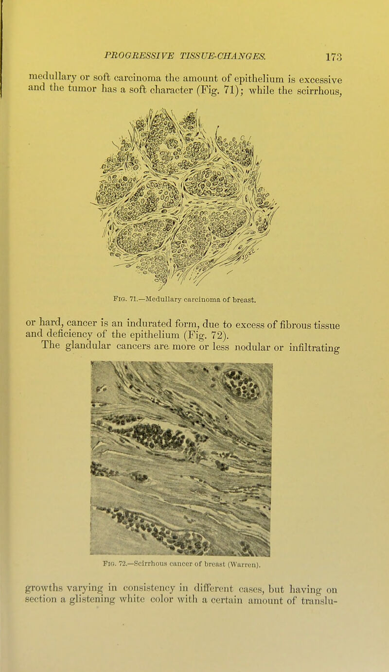 medullary or soft carcinoma the amount of epithelium is excessive and the tumor has a soft character (Fig. 71); while the scirrhous, Fig. 71.—Medullary carcinoma of breast. or hard, cancer is an indurated form, due to excess of fibrous tissue and deficiency of the epithelium (Fig. 72). The glandular cancers are more or less nodular or infiltrating Fig. 72.—Scirrhous cancer of breast (Warren). growths varying in consistency in different cases, but having on section a glistening white color with a certain amount of translu-