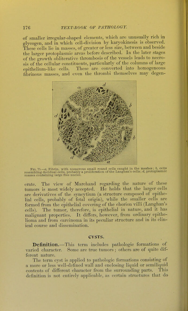 of smaller irregular-shaped elements, which are imusually rich in glycogen, and in which cell-division by karyokinesis is observed. These cells lie in masses, of greater or less size, between and beside the larger protoplasmic areas before described. In the later stages of the growth obliterative thrombosis of the vessels leads to necro- sis of the cellular constituents, particularly of the columns of large epithelium-like cells. These are converted into homogeneous fibrinous masses, and even the thrombi themselves may degen- d Fig Ih.—a, Fibrin, with numerous small round cells caught in the meshes; 6, cells resembling decidual cells, prohably a proliferation of the Langhan's cells; d, protoplasmic masses containing large free nuclei. erate. The view of Marchand regarding the nature of these tumors is most widely accepted. He holds that the larger cells are derivatives of the syncytium (a structure composed of epithe- lial cells, probably of fetal origin), while the smaller cells are formed from the epithelial covering of the chorion villi (Langhan's cells). The tumor, therefore, is epithelial in nature, and it has malignant properties. It differs, however, from ordinary epithe- lioma and from carcinoma in its peculiar structure and in its clin- ical course and dissemination. CYSTS. Definition.—This term includes pathologic formations of varied character. Some are true tumors ; others are of quite dif- ferent nature. The term cyst is applied to pathologic formations consisting of a more or less well-defined wall and enclosing liquid or semiliquid contents of different character from the surrounding parts. This definition is not entirely applicable, as certain structures that do