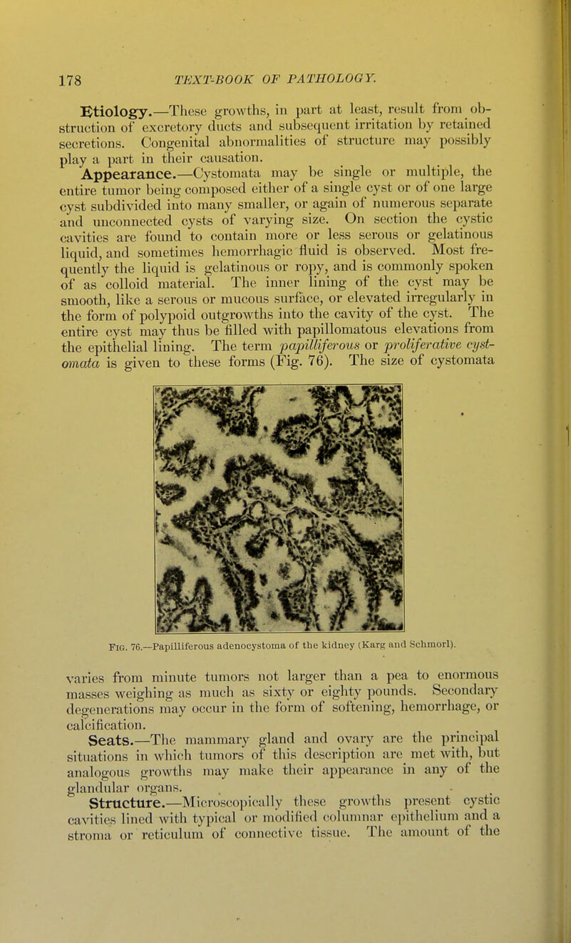 IStiology.—These growths, in part at least, result from ob- struction of excretory ducts and subsequent irritation by retained secretions. Congenital abnormalities of structure may possibly play a part in their causation. Appearance.—Cystomata may be single or multiple, the entire tumor being composed either of a single cyst or of one large cyst subdivided into many smaller, or again of numerous separate and unconnected cysts of varying size. On section the cystic cavities are found to contain more or less serous or gelatinous liquid, and sometimes hemorrhagic fluid is observed. Most fre- quently the liquid is gelatinous or ropy, and is commonly spoken of as colloid material. The inner lining of the cyst may be smooth, like a serous or mucous surface, or elevated irregularly in the form of polypoid outgrowths into the cavity of the cyst. The entire cyst may thus be filled with papillomatous elevations from the epithelial lining. The term papuliferous or proliferative cyst- rnnata is given to these forms (Fig. 76). The size of cystomata Fig. 76.—Papilliferous adenocystoma of the kidney (Karg and Schmorl). varies from minute tumors not larger than a pea to enormous masses weighing as much as sixty or eighty pounds. Secondary degenerations may occur in the form of softening, hemorrhage, or calcification. Seats.—The mammary gland and ovary are the principal situations in which tumors of this description are met with, but analogous growths may make their appearance in any of the glandular organs. Structure.—Microscopically these growths present cystic cavities lined with typical or modified columnar o])ithelium and a stroma or reticulum of connective tissue. The amount of the