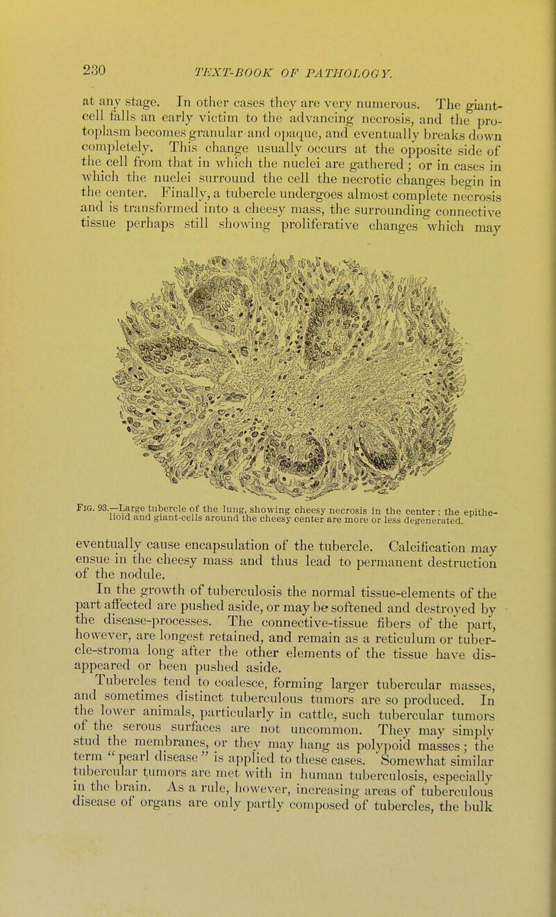 at any stage. In other cases they are very numerous. The giant- cell falls an early victina to the advancing necrosis, and the pro- toplasm becomes granular and o])aque, and eventually breaks down completely. This change usually occurs at the opposite side of the cell from that in which the nuclei are gathered ; or in cases in which the nuclei surround the cell the necrotic changes begin in the center. Finally, a tubercle undergoes almost complete necrosis and is transformed into a cheesy mass, the surrounding connective tissue perhaps still showing proliferative changes which may Fig. 93.—Large tubercle of the lung, showing cheesy necrosis in the center : the enithe- lioid and giant-cells around the cheesy center are more or less degenerated. eventually cause encapsulation of the tubercle. Calcification may ensue in the cheesy mass and thus lead to permanent destruction of the nodule. In the growth of tuberculosis the normal tissue-elements of the part affected are pushed aside, or may be softened and destroyed by the disease-processes. The connective-tissue fibers of the part, however, are longest retained, and remain as a reticulum or tuber- cle-stroma long after the other elements of the tissue have dis- appeared or been pushed aside. Tubercles tend to coalesce, forming larger tubercular masses, and sometimes distinct tuberculous timiors are so produced. In the lower animals, particularly in cattle, such tubercular tumors of the serous surfaces are not uncommon. They may simply stud the membranes, or they may hang as polypoid masses; the term  pearl disease  is applied to these cases.  SomeAvhat similar tubercular tumors are met with in human tuberculosis, especially in the braui. As a rule, however, increasing areas of tuberculous disease of organs are only partly composed of tubercles, the bulk