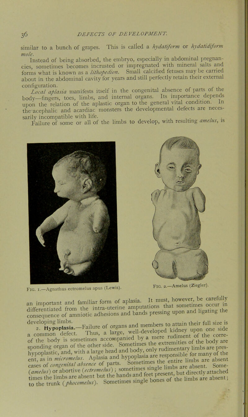 similar to a bunch of grapes. This is calied a hydatiform or hydatidiform mole. Instead of being absorbed, the embryo, especially in abdominal pregnan- cies, sometimes becomes incrusted or impregnated with mineral salts and forms what is known as a lithopedion. Small calcified fetuses may be carried about in the abdominal cavity for years and still perfectly retain their external configuration. Local aplasia manifests itself in the congenital absence of parts oi the body—fingers, toes, limbs, and internal organs. Its importance depends upon the relation of the aplastic organ to the general vital condition. In the-acephalic and acardiac monsters the developmental defects are neces- sarily incompatible with life. . Failure of some or all of the limbs to develop, with resulting amelus, is Fig. i.—Agnathus ectromelus apus (Lewis). FIG. 2.—Amelus (Ziegler). an important and familiar form of aplasia It must. ocfur''in a common defect. 1 nus, a large, mdimpnt of the corre- of the body is sometimes accompanied by a me c . . , j (amelus) or abortive (ectromelus) ( sometimes sing 1 l directly attached