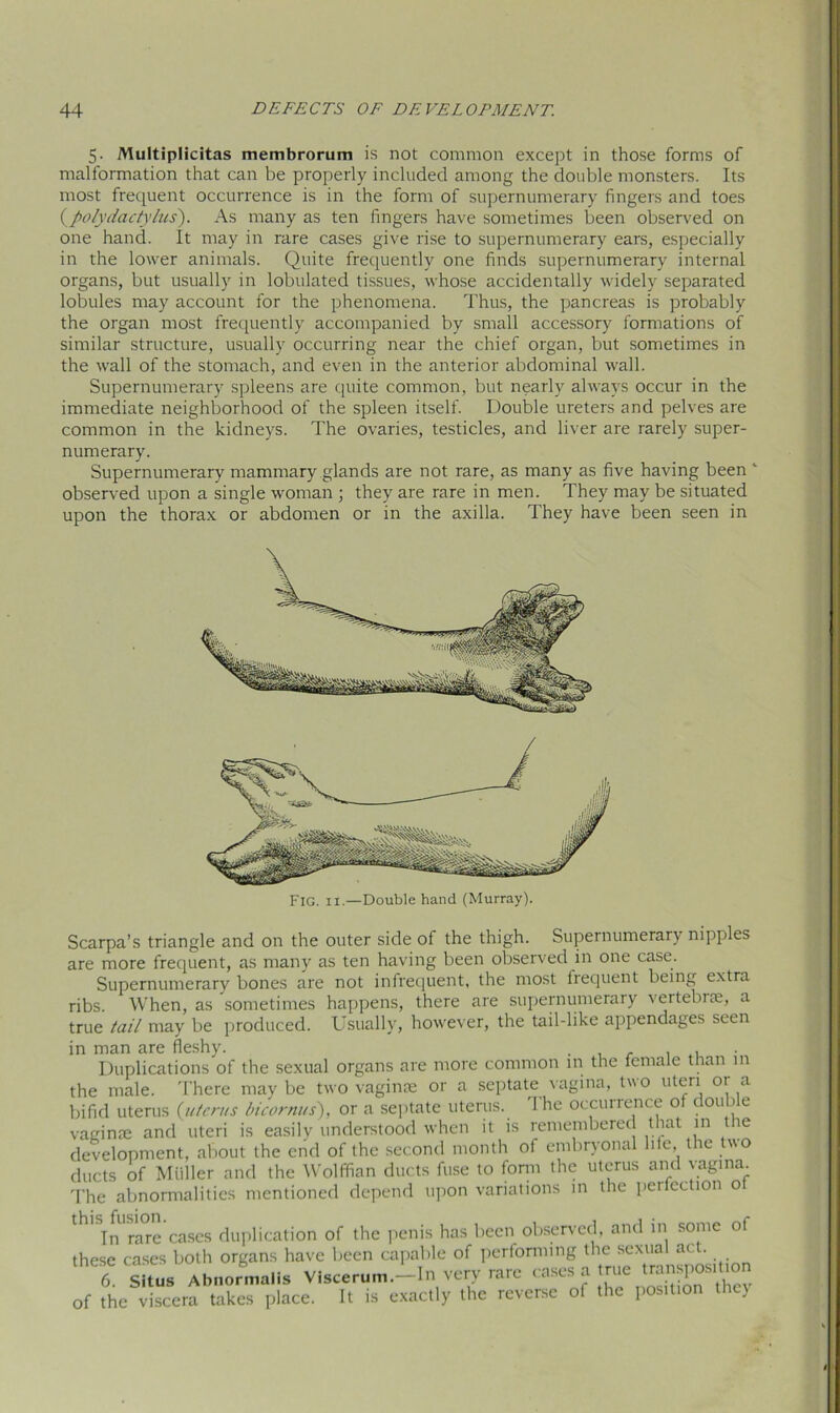 5. Multiplicitas membrorum is not common except in those forms of malformation that can be properly included among the double monsters. Its most frequent occurrence is in the form of supernumerary fingers and toes {polydactylics'). As many as ten fingers have sometimes been observed on one hand. It may in rare cases give rise to supernumerary ears, especially in the lower animals. Quite frequently one finds supernumerary internal organs, but usually in lobulated tissues, whose accidentally widely separated lobules may account for the phenomena. Thus, the pancreas is probably the organ most frequently accompanied by small accessory formations of similar structure, usually occurring near the chief organ, but sometimes in the wall of the stomach, and even in the anterior abdominal wall. Supernumerary spleens are quite common, but nearly always occur in the immediate neighborhood of the spleen itself. Double ureters and pelves are common in the kidneys. The ovaries, testicles, and liver are rarely super- numerary. Supernumerary mammary glands are not rare, as many as five having been 1 observed upon a single woman ; they are rare in men. They may be situated upon the thorax or abdomen or in the axilla. They have been seen in Fig. ix.—Double hand (Murray). Scarpa’s triangle and on the outer side of the thigh. Supernumerary nipples are more frequent, as many as ten having been observed in one case. Supernumerary bones are not infrequent, the most frequent being extra ribs. When, as sometimes happens, there are supernumerary vertebue, a true tail may be produced. Usually, however, the tail-like appendages seen in man are fleshy. . ... Duplications of the sexual organs are more common in the female than in the male. There may be two vaginae or a septate vagina, two uteri or a bifid uterus (uterus bicornus), or a septate uterus. The occurrence of double vaginae and uteri is easily understood when it is remembered that in the development, about the end of the second month of embryonal hie, the two ducts of Midler and the Wolffian ducts fuse to form the uterus and vagina. The abnormalities mentioned depend upon variations m the peiiection o th,SInUrare cases duplication of the penis has been observed, and in some ot these cases both organs have been capable of performing the sexual act. 6. Situs Abnormaiis Viscerum—In very rare cases a true transposition of the viscera takes place. It is exactly the reverse of the position the)