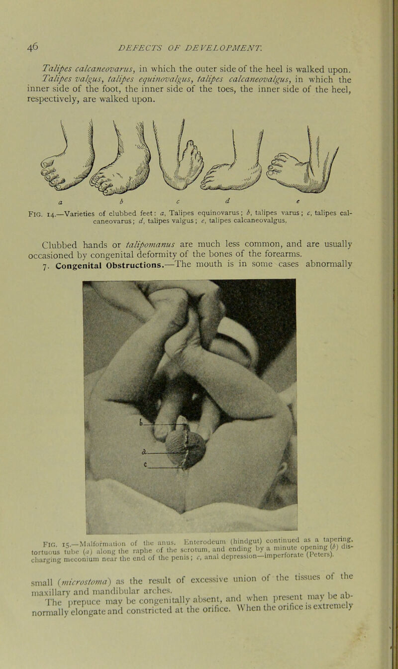 Talipes calcaneovarus, in which the outer side of the heel is walked upon. Talipes valgus, talipes equinovalgus, talipes calcaneovalgus, in which the inner side of the foot, the inner side of the toes, the inner side of the heel, respectively, are walked upon. Fig. 14.—Varieties of clubbed feet: a, Talipes equinovarus; b, talipes varus ; c, talipes cal- caneovarus ; d, talipes valgus ; e, talipes calcaneovalgus. Clubbed hands or talipomanus are much less common, and are usually occasioned by congenital deformity of the bones of the forearms. 7. Congenital Obstructions.—The mouth is in some cases abnormally FIG. 15.—Malternation of the anus. Enterodeum (hindgut) continued “ “ ta~nng tortuous tube U, along the raphe of the scrotum, and ending by a minute opening (->) dis charging meconium near the end of the penis; c, anal depression-tmperforate (Peters). small (microstoma) as the result of excessive union of the tissues of the maxillary and mandibular arches. . ■ v The prepuce may be congenitally absent, and when present nun > * normally elongate Jl construed at the orifice. When the Office is extremely