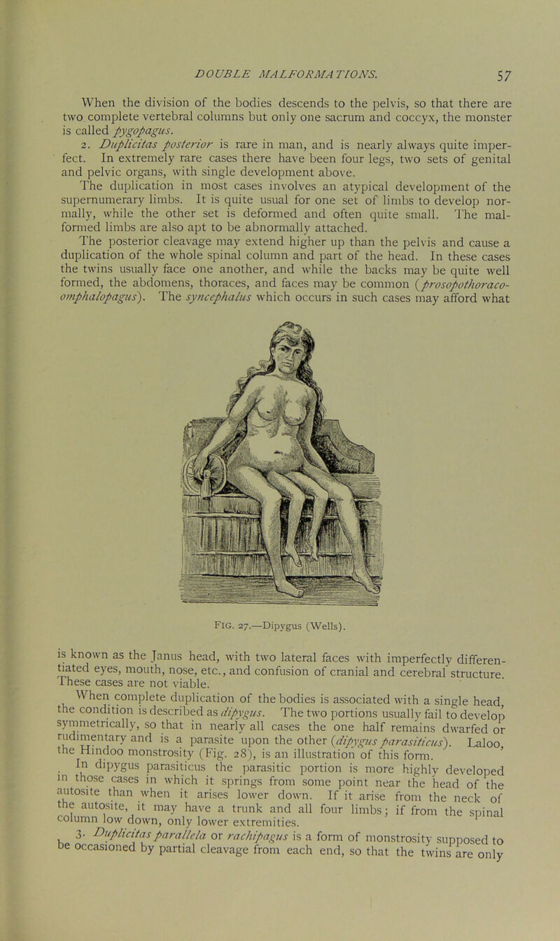 When the division of the bodies descends to the pelvis, so that there are two complete vertebral columns but only one sacrum and coccyx, the monster is called pygopagus. 2. Duplicitas posterior is rare in man, and is nearly always quite imper- fect. In extremely rare cases there have been four legs, two sets of genital and pelvic organs, with single development above. The duplication in most cases involves an atypical development of the supernumerary limbs. It is quite usual for one set of limbs to develop nor- mally, while the other set is deformed and often quite small. The mal- formed limbs are also apt to be abnormally attached. The posterior cleavage may extend higher up than the pelvis and cause a duplication of the whole spinal column and part of the head. In these cases the twins usually face one another, and while the backs may be quite well formed, the abdomens, thoraces, and faces may be common (prosopothoraco- omphalopagus). The syncephalus which occurs in such cases may afford what Fig. 27.—Dipvgus (Wells). is known as the Janus head, with two lateral faces with imperfectly differen- tiated eyes, mouth, nose, etc., and confusion of cranial and cerebral structure. These cases are not viable. When complete duplication of the bodies is associated with a single head, the condition is described as dipygus. The two portions usually fail to develop symmetrically, so that in nearly all cases the one half remains dwarfed or rudimentary and is a parasite upon the other (dipygusparasiticus). Laloo the Hindoo monstrosity (Fig. 28), is an illustration of this form. In dipygus parasiticus the parasitic portion is more highly developed in those cases in which it springs from some point near the head of the autosite than when it arises lower down. If it arise from the neck of the autosite, it may have a trunk and all four limbs; if from the spinal column low down, only lower extremities. 3- Duplicitaspara/lela or rachipagus is a form of monstrosity supposed to be occasioned by partial cleavage from each end, so that the twins are only