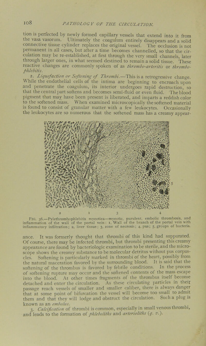 io8 tion is perfected by newly formed capillary vessels that extend into it from the vasa vasorum. Ultimately the coagulum entirely disappears and a solid connective tissue cylinder replaces the original vessel. The occlusion is not permanent in all cases, but after a time becomes channelled, so that the cir- culation may be re-established, at first through the very small channels, later through larger ones, in what seemed destined to remain a solid tissue. These reactive changes are commonly spoken of as thrombo-arteritis or thrombo- phlebitis. 2. Liquefaction or Softening of Thrombi.—This is a retrogressive change. While the endothelial cells of the intima are beginning to encroach upon and penetrate the coagulum, its interior undergoes rapid destruction, so that the central part softens and becomes semi-fluid or even fluid. The blood pigment that may have been present is liberated, and imparts a reddish color to the softened mass. When examined microscopically the softened material is found to consist of granular matter with a few leukocytes. Occasionally the leukocytes are so numerous that the softened mass has a creamy appear- Fig. 36.—Pylethromb.ophlebitis mycotica—mycotic, purulent, embolic thrombosis, and inflammation of the wall of the portal vein : 1, Wall of the branch of the portal vein with inflammatory infiltration; 2, liver tissue; 3, zone of necrosis; 4, pus; 5, groups of bacteria. ance. It was formerly thought that thrombi of this kind had suppurated. Of course, there may be infected thrombi, but thrombi presenting this creamy appearance are found by bacteriologic examination to be sterile, and the micro- scope shows the creamy substance to be molecular detritus without pus corpus- cles. Softening is particularly marked in thrombi of the heart, possibly from the natural maceration favored by the surrounding blood. It is said that the softening of the thrombus is favored by febrile conditions. In the process of softening rupture may occur and the softened contents ol the mass escape into the blood. At other times fragments of the thrombus itsell become detached and enter the circulation. As these circulating particles in theit passage reach vessels of smaller and smaller caliber, there is always danger that at some point of bifurcation the vessel will become too small to admit them and that they will lodge and obstruct the circulation. Such a plug is known as an embolus. 3. Calcification of thrombi is common, especially in small venous thrombi, and leads to the formation of phleboliths and artenoliths (q. ?'•)•