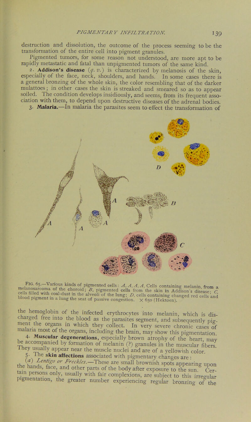 destruction and dissolution, the outcome of the process seeming to be the transformation of the entire cell into pigment granules. Pigmented tumors, for some reason not understood, are more apt to be rapidly metastatic and fatal than unpigmented tumors of the same kind. 2. Addison’s disease (q.v.) is characterized by melanosis of the skin, especially of the face, neck, shoulders, and hands. In some cases there is a general bronzing of the whole skin, the color resembling that of the darker mulattoes; in other cases the skin is streaked and smeared so as to appear soiled. I he condition develops insidiously, and seems, from its frequent asso- ciation with them, to depend upon destructive diseases of the adrenal bodies. 3- Malaria.—In malaria the parasites seem to effect the transformation of fIG. 65.—Various kinds of pigmented cells : A, A, A, A, Cells containing melanin from a melanosarcoma of the choroid; B, pigmented cells from the skin in Addison's disease- C h?nor|fi 6d wl*coal-dust 'n ,he alveoli of the lung; D, cells containing changed red cells 'and blood pigment in a lung the seat of passive congestion. X 650 (Hektoen). the hemoglobin of the infected erythrocytes into melanin, which is dis- charged free into the blood as the parasites segment, and subsequently nm- ment the organs in which they collect. In very severe chronic cases of malaria most of the organs, including the brain, may show this pigmentation. 4- Muscular degenerations, especially brown atrophy of the heart mav be accompanied by formation of melanin (?) granules in the muscular fibers^ they usually appear near the muscle nuclei and are of a yellowish color. 5- I he skin affections associated with pigmentary changes are : v Lent’S° or Freckles. These are small brownish spots appearing upon he hands, face, and other parts of the body after exposure to the sun Cer am persons only, usually with fair complexions, are subject to this irregular pigmentation, the greater number experiencing regular bronzing of the