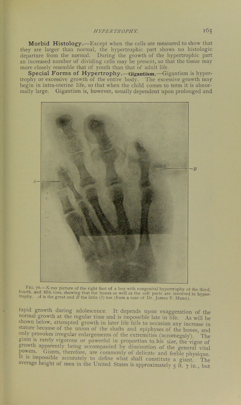 Morbid Histology.—Except when the cells are measured to show that they are larger than normal, the hypertrophic part shows no histologic departure from the normal. During the growth of the hypertrophic part an increased number of dividing cells may be present, so that the tissue may more closely resemble that of youth than that of adult life. Special Forms of Hypertrophy.—Gigantism.—Gigantism is hyper- trophy or excessive growth of the entire body. The excessive growth may begin in intra-uterine life, so that when the child comes to term it is abnor- mally large. Gigantism is, however, usually dependent upon prolonged and Fig. 76.—X-ray picture of the right foot of a boy with congenital hypertrophy of the third, fourth, and fifth toes, showing that the bones as well as the soft parts are involved in hyper- trophy. A is the great and B the little (?) toe (from a case of Dr. James P. Mann). rapid growth during adolescence. It depends upon exaggeration of the normal growth at the regular time and is impossible late in life. As will be shown below, attempted growth in later life fails to occasion any increase in stature because of the union of the shafts and epiphyses of the bones, and only provokes irregular enlargements of the extremities (acromegaly). ’ The giant is rarely vigorous or powerful in proportion to his size, the’vigor of growth apparently being accompanied by diminution of the general vital powers. Giants, therefore, are commonly of delicate and feeble physique. It is impossible accurately to define what shall constitute a giant’ The average height of men in the United States is approximately 5 ft. 7 in., but