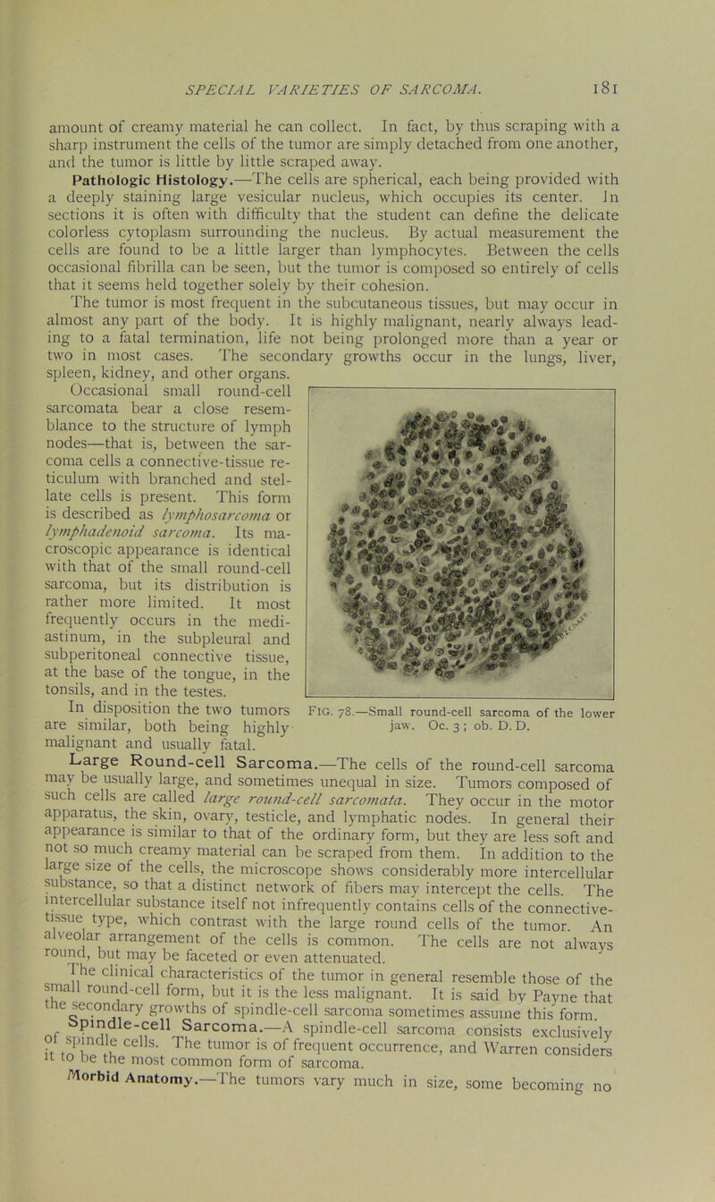 m * wm an w *jifij- '*■ amount of creamy material he can collect. In fact, by thus scraping with a sharp instrument the cells of the tumor are simply detached from one another, and the tumor is little by little scraped away. Pathologic Histology.—The cells are spherical, each being provided with a deeply staining large vesicular nucleus, which occupies its center. In sections it is often with difficulty that the student can define the delicate colorless cytoplasm surrounding the nucleus. By actual measurement the cells are found to be a little larger than lymphocytes. Between the cells occasional fibrilla can be seen, but the tumor is composed so entirely of cells that it seems held together solely by their cohesion. The tumor is most frequent in the subcutaneous tissues, but may occur in almost any part of the body. It is highly malignant, nearly always lead- ing to a fatal termination, life not being prolonged more than a year or two in most cases. The secondary growths occur in the lungs, liver, spleen, kidney, and other organs. Occasional small round-cell sarcomata bear a close resem- blance to the structure of lymph nodes—that is, between the sar- coma cells a connective-tissue re- ticulum with branched and stel- late cells is present. This form is described as lymphosarcoma or lymphadenoid sarcoma. Its ma- croscopic appearance is identical with that of the small round-cell sarcoma, but its distribution is rather more limited. It most frequently occurs in the medi- astinum, in the subpleural and subperitoneal connective tissue, at the base of the tongue, in the tonsils, and in the testes. In disposition the two tumors are similar, both being highly malignant and usually fatal. Large Round-cell Sarcoma.—The cells of the round-cell sarcoma may be usually large, and sometimes unequal in size. Tumors composed of such cells are called large round-cell sarcomata. They occur in the motor apparatus, the skin, ovary, testicle, and lymphatic nodes. In general their appearance is similar to that of the ordinary form, but they are less soft and not so much creamy material can be scraped from them. In addition to the large size of the cells, the microscope shows considerably more intercellular substance, so that a distinct network of fibers may intercept the cells. The inteicellular substance itself not infrequently contains cells of the connective- tissue type, which contrast with the large round cells of the tumor. An alveolar arrangement of the cells is common. The cells are not always round, but may be faceted or even attenuated. 1 he clinical characteristics of the tumor in general resemble those of the smalt round-cell form, but it is the less malignant. It is said by Payne that ne secondary growths of spindle-cell sarcoma sometimes assume this form, of c P11?, e<e11 Sarcoma-—A spindle-cell sarcoma consists exclusively hffo Wu Ce S' The tUmor 15 of frecll,ent occurrence, and Warren considers u co be the most common form of sarcoma. 7# Fig. 78.—Small round-cell sarcoma of the lower jaw. Oc. 3 ; ob. D. D. Morbid Anatomy.—The tumors vary much in size, some becoming no