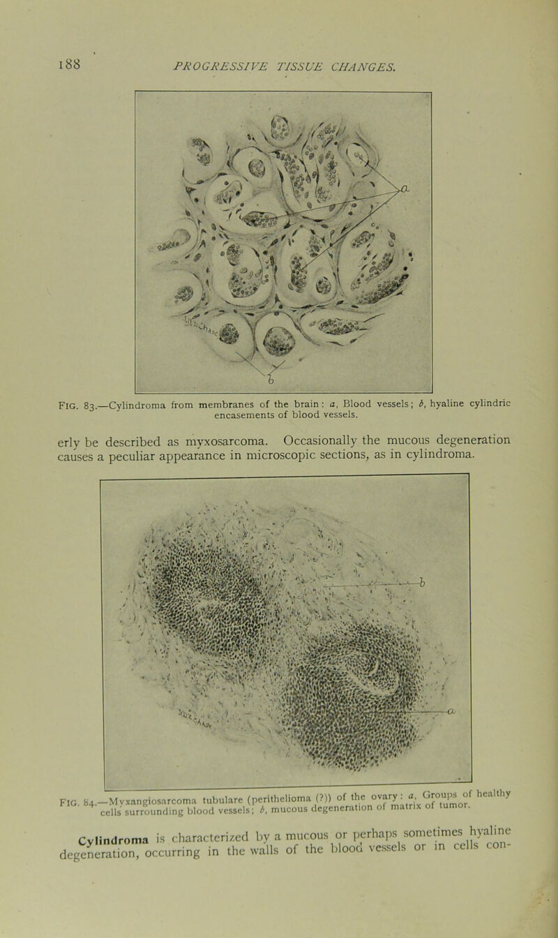 Fig. 83.—Cylindroma from membranes of the brain: a, Blood vessels; 6, hyaline cylindric encasements of blood vessels. erly be described as myxosarcoma. Occasionally the mucous degeneration causes a peculiar appearance in microscopic sections, as in cylindroma. 'IG. 84.—Mvxangiosarcoma tubulare (perithelioma (?)) of the ov“ry ' <>f hcallliy 4 cells surrounding blood vessels; 6. mucous degeneration of matrix of tumor. Cylindroma is characterized by a mucous or perhaps sometimes hyaline degeneration, occurring in the walls of the blooo vessels or in cc s