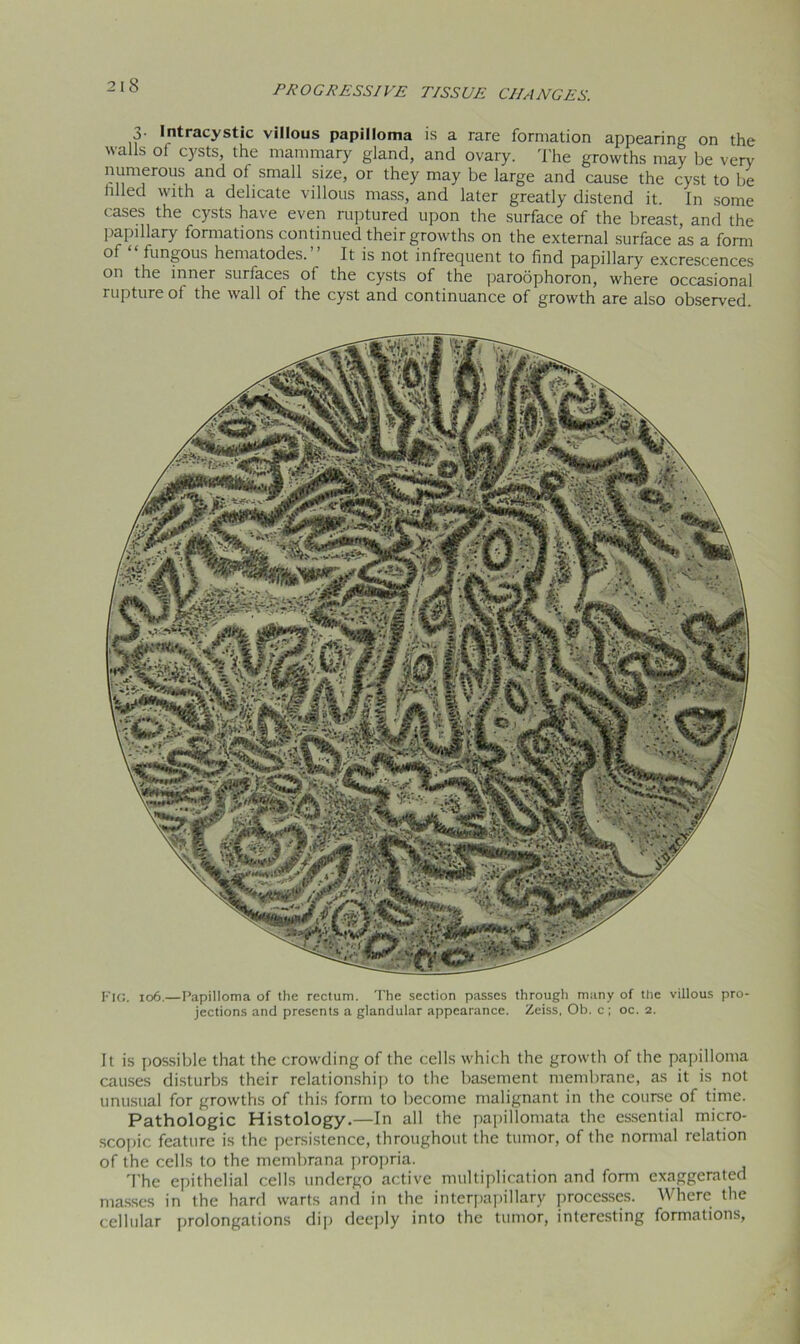 3- Intracystic villous papilloma is a rare formation appearing on the walls ol cysts, the mammary gland, and ovary. The growths may be very numerous and of small size, or they may be large and cause the cyst to be fiHed with a delicate villous mass, and later greatly distend it. In some cases the cysts have even ruptured upon the surface of the breast, and the papillary formations continued their growths on the external surface as a form of fungous hematodes. It is not infrequent to find papillary excrescences on the inner surfaces of the cysts of the paroophoron, where occasional rupture of the wall of the cyst and continuance of growth are also observed. Fig. 106.—Papilloma of the rectum. The section passes through many of the villous pro- jections and presents a glandular appearance. Zeiss, Ob. c; oc. 2. It is possible that the crowding of the cells which the growth of the papilloma causes disturbs their relationship to the basement membrane, as it is not unusual for growths of this form to become malignant in the course of time. Pathologic Histology.—In all the papillomata the essential micro- scopic feature is the persistence, throughout the tumor, of the normal relation of the cells to the membrana propria. The epithelial cells undergo active multiplication and form exaggerated masses in the hard warts and in the interpapillary processes. Where the cellular prolongations dip deeply into the tumor, interesting formations,